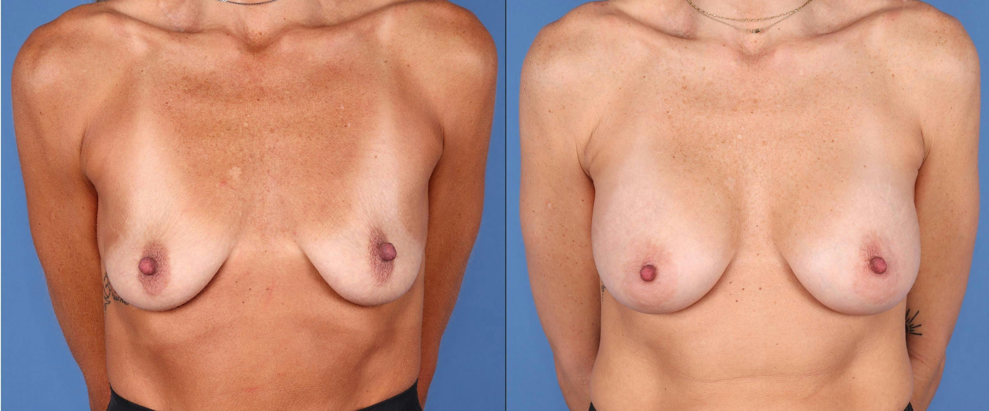 Breast Augmentation Before & After Gallery - Patient 146131738 - Image 1