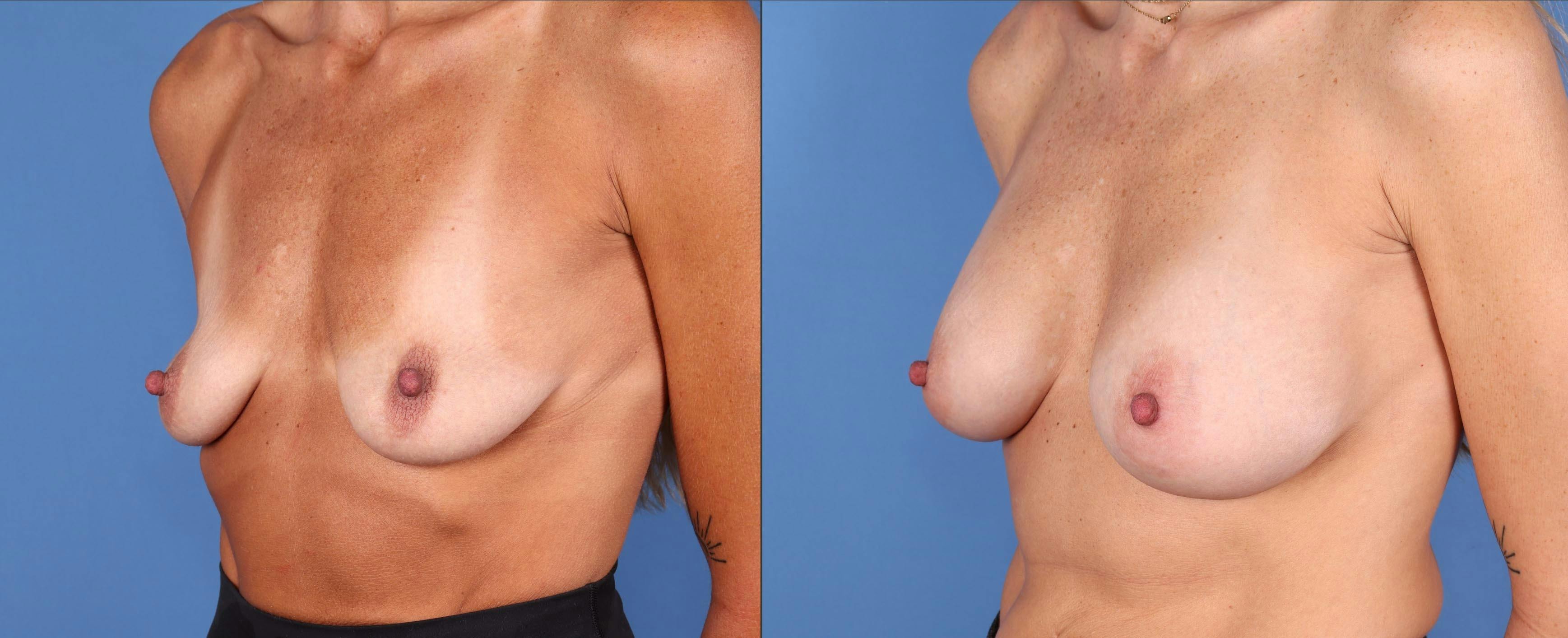 Breast Augmentation Before & After Gallery - Patient 146131738 - Image 2