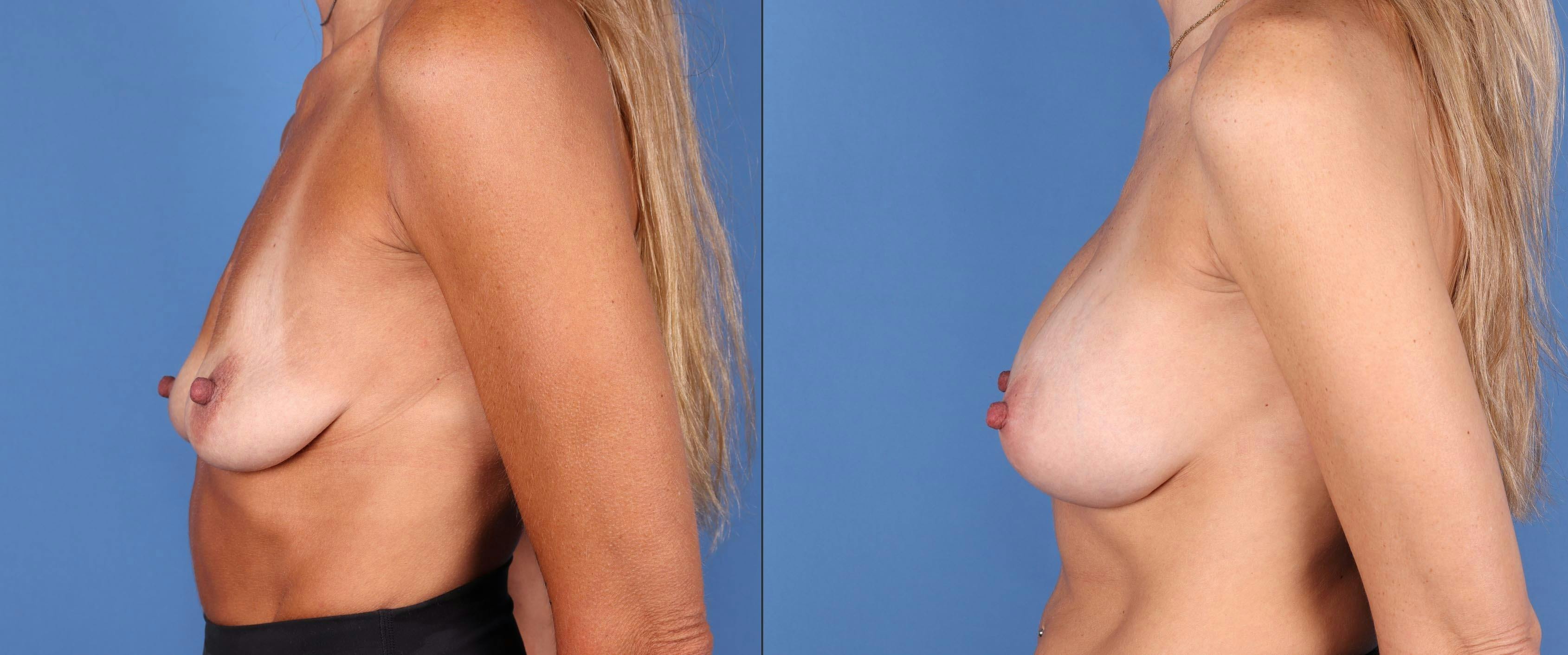 Breast Augmentation Before & After Gallery - Patient 146131738 - Image 3