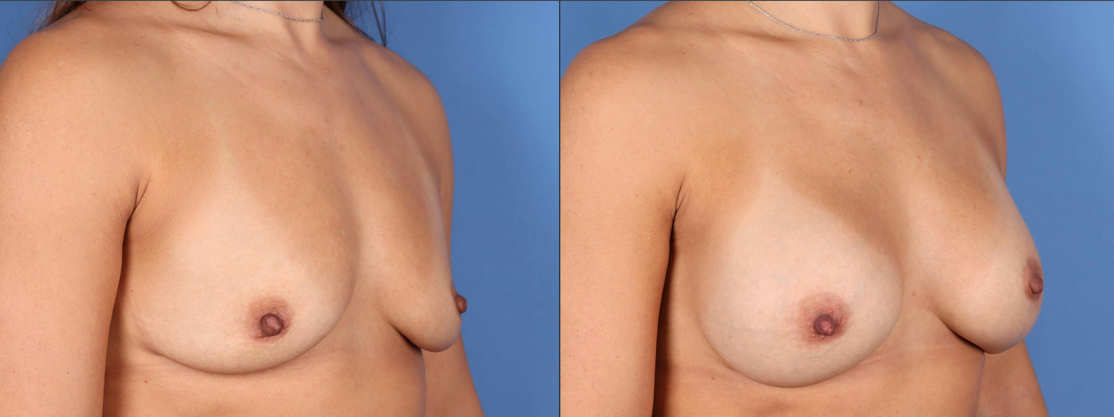 Breast Augmentation Before & After Gallery - Patient 146131971 - Image 2