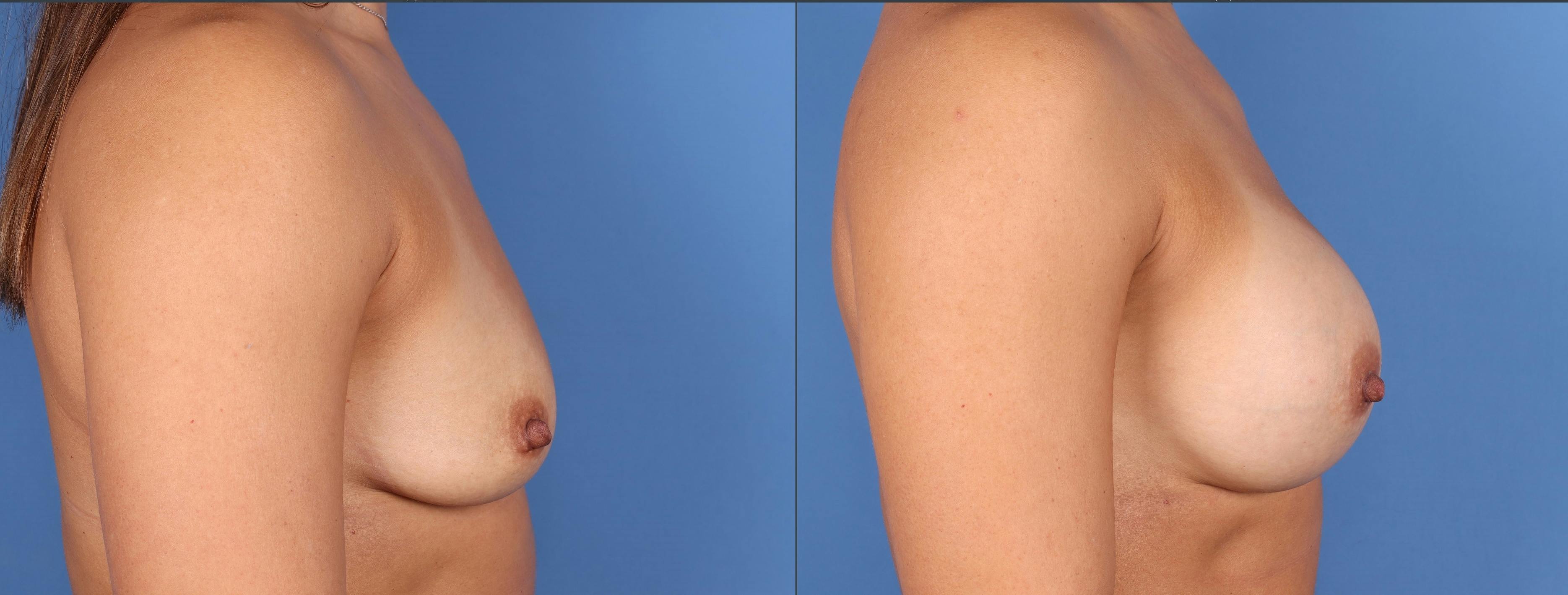 Breast Augmentation Before & After Gallery - Patient 146131971 - Image 3