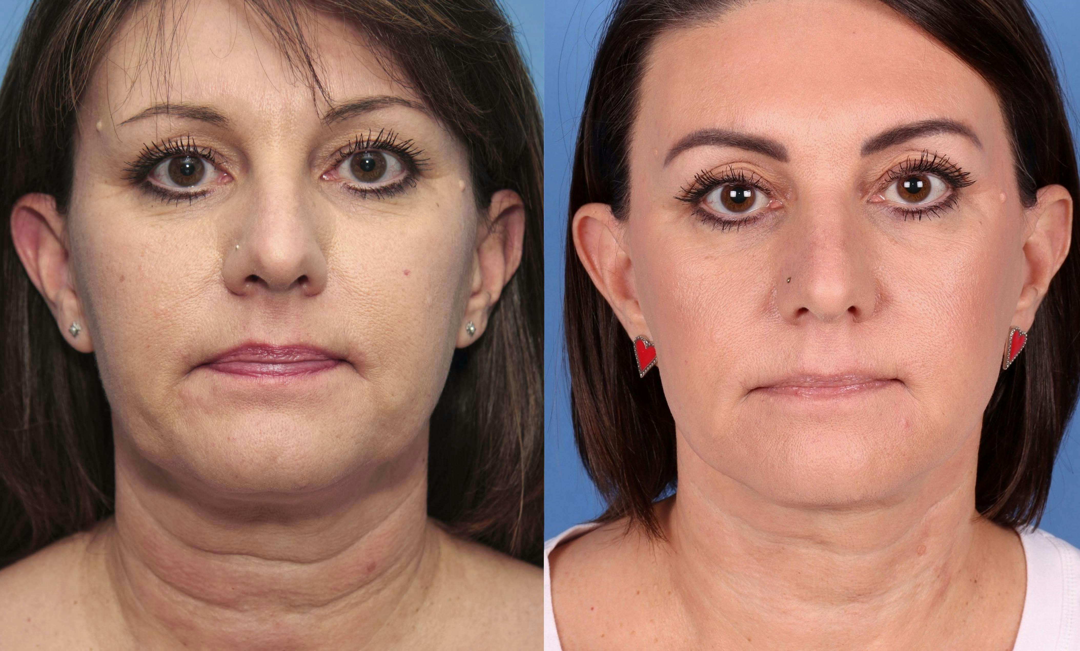Face Lift Before & After Gallery - Patient 146484410 - Image 1