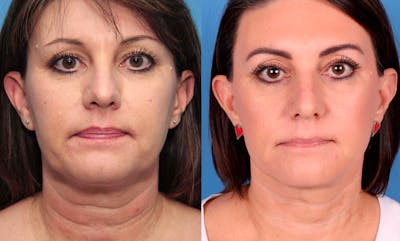 Face Lift Before & After Gallery - Patient 146484410 - Image 1