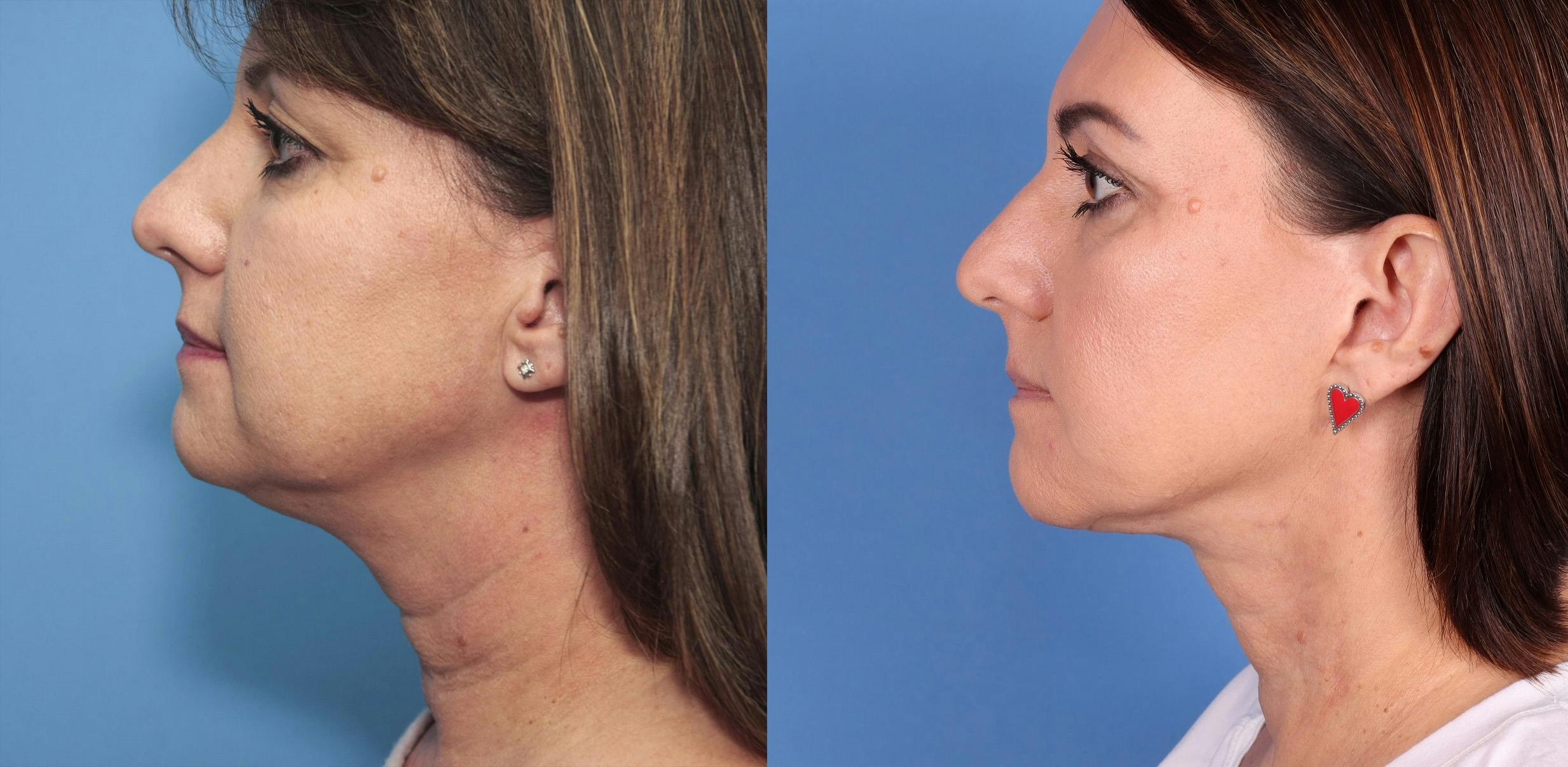Neck Lift Before & After Gallery - Patient 146484411 - Image 1