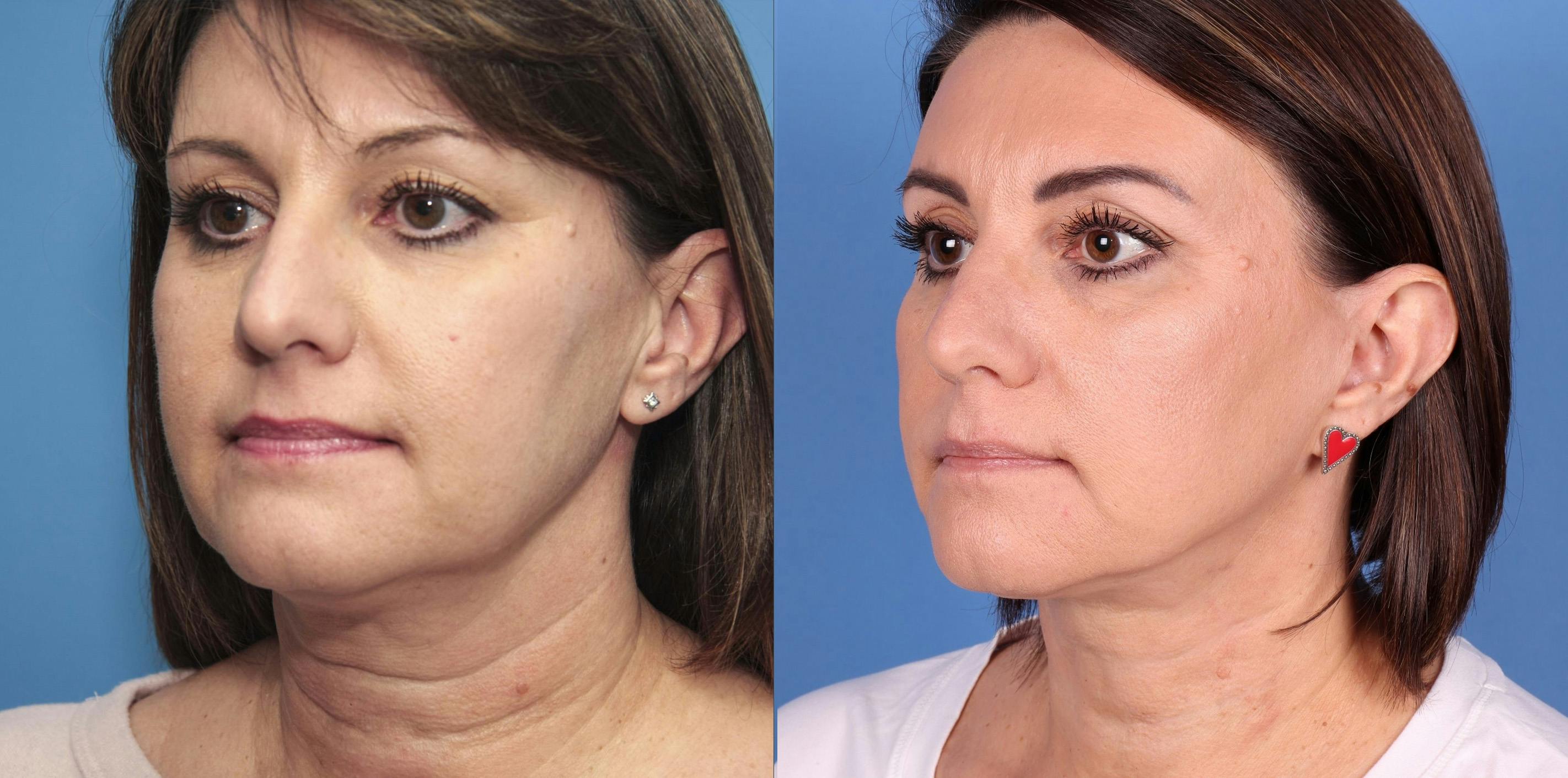 Neck Lift Before & After Gallery - Patient 146484411 - Image 2