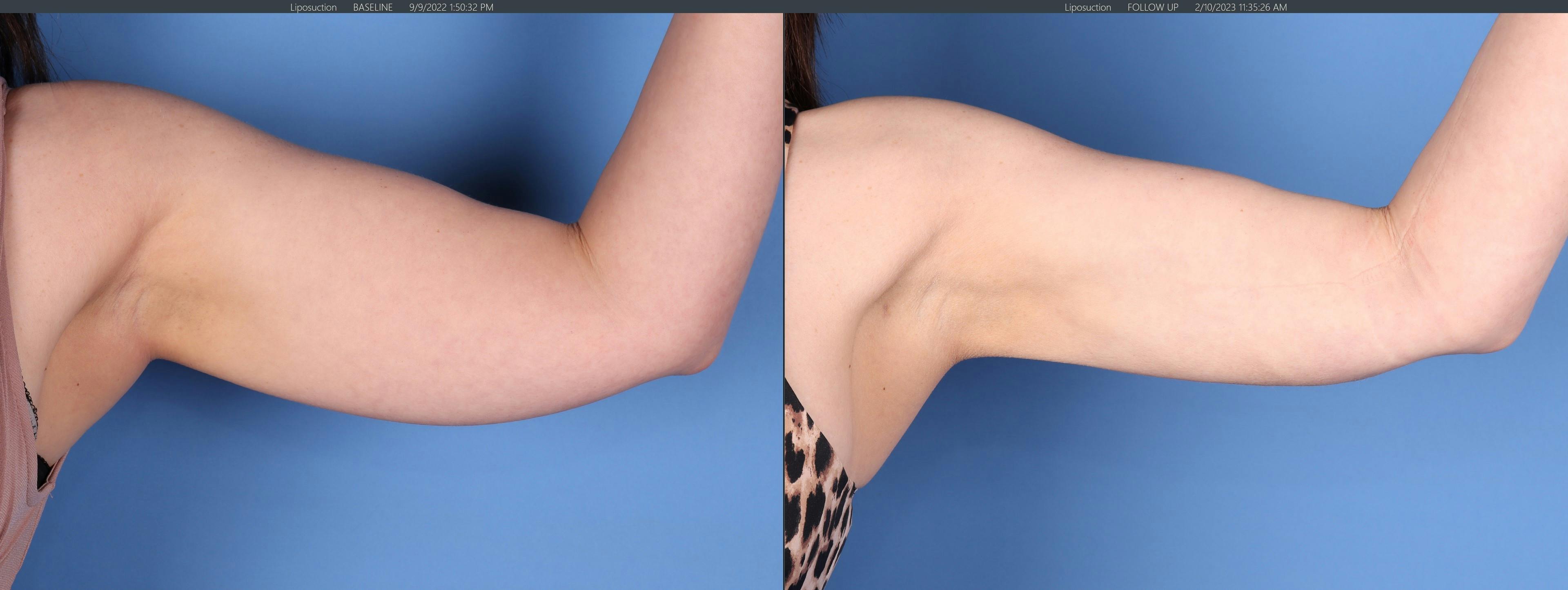 Arms Before & After Gallery - Patient 149385358 - Image 1