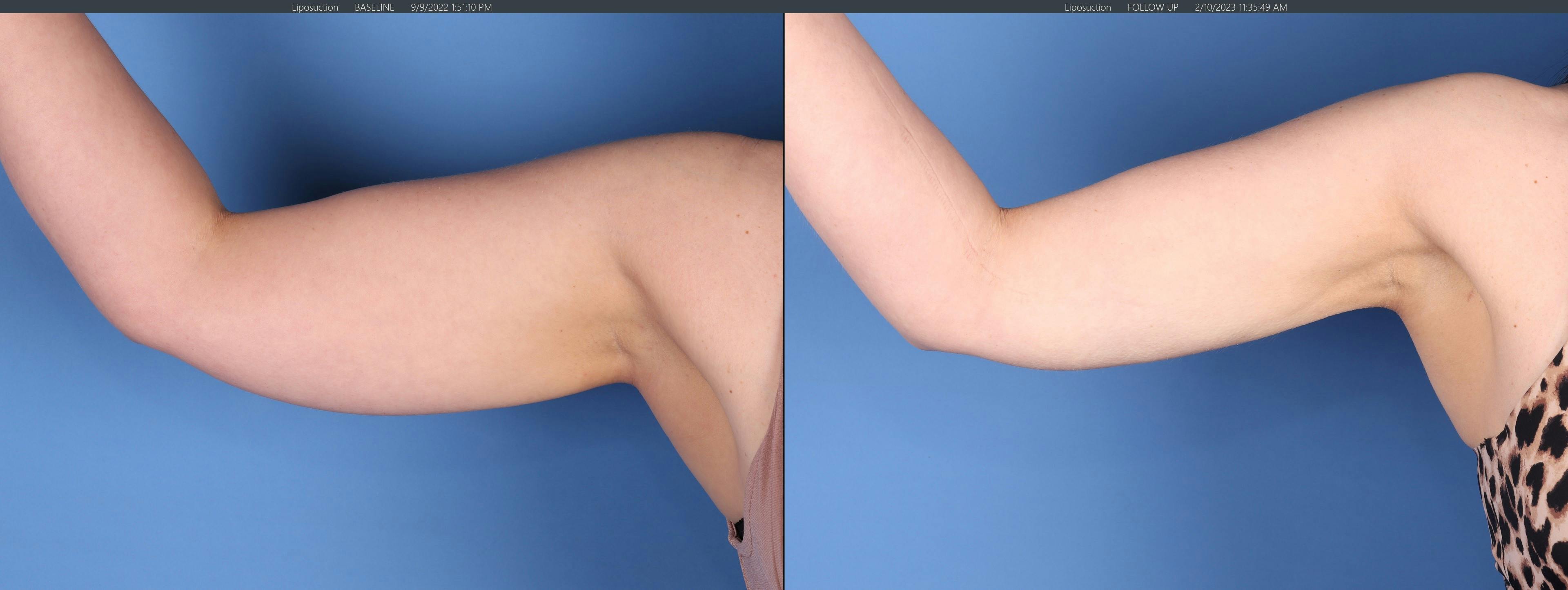 Arms Before & After Gallery - Patient 149385358 - Image 2