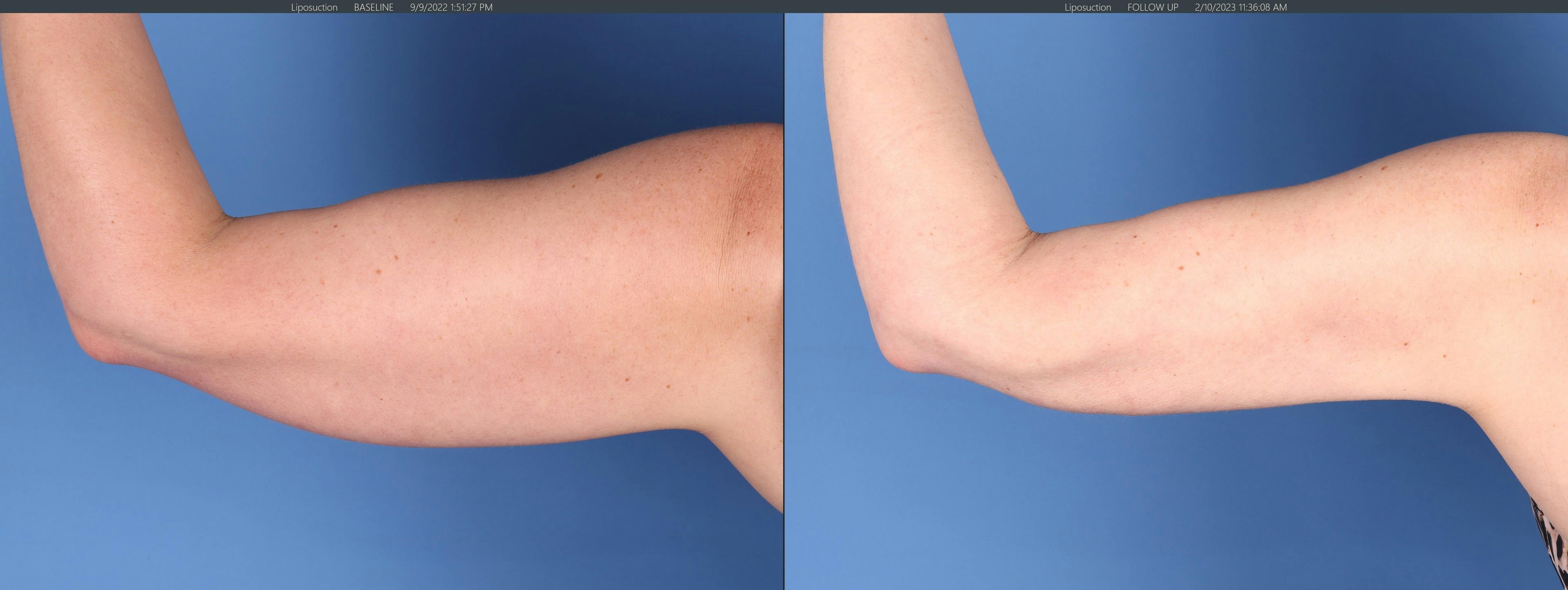 Arms Before & After Gallery - Patient 149385358 - Image 3