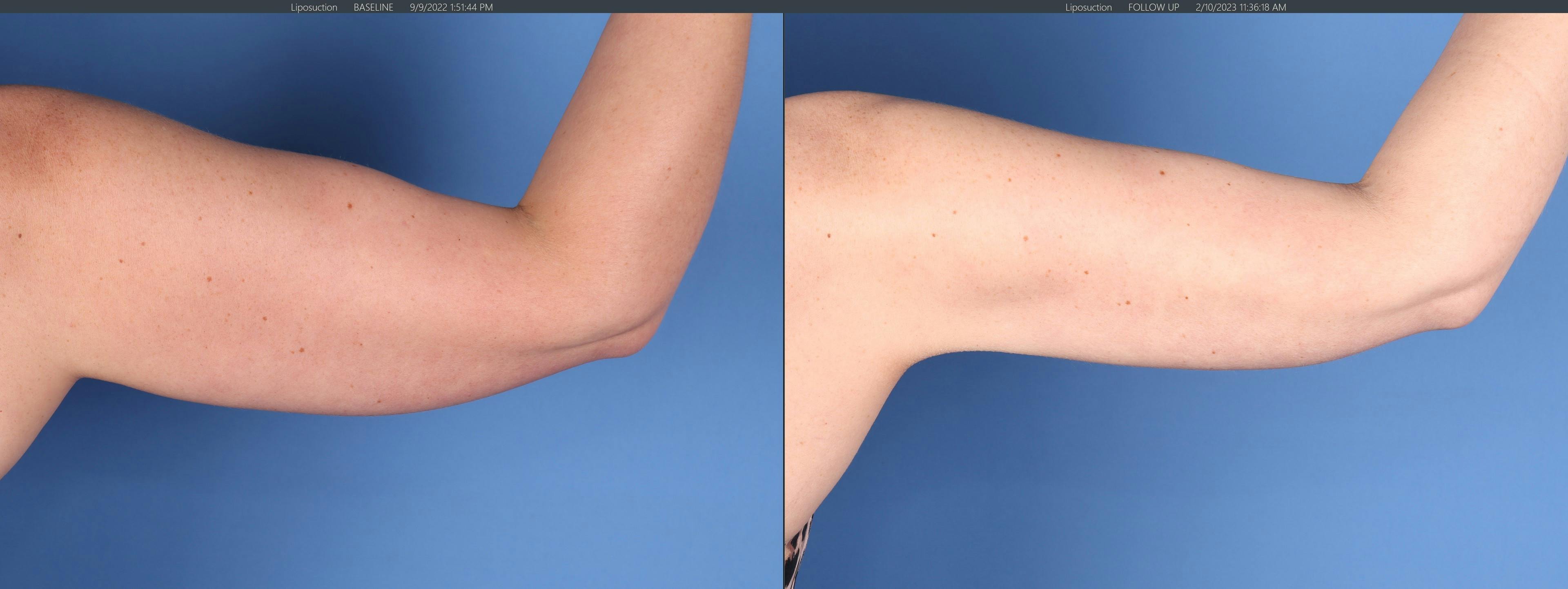 Liposuction Before & After Gallery - Patient 146484412 - Image 4