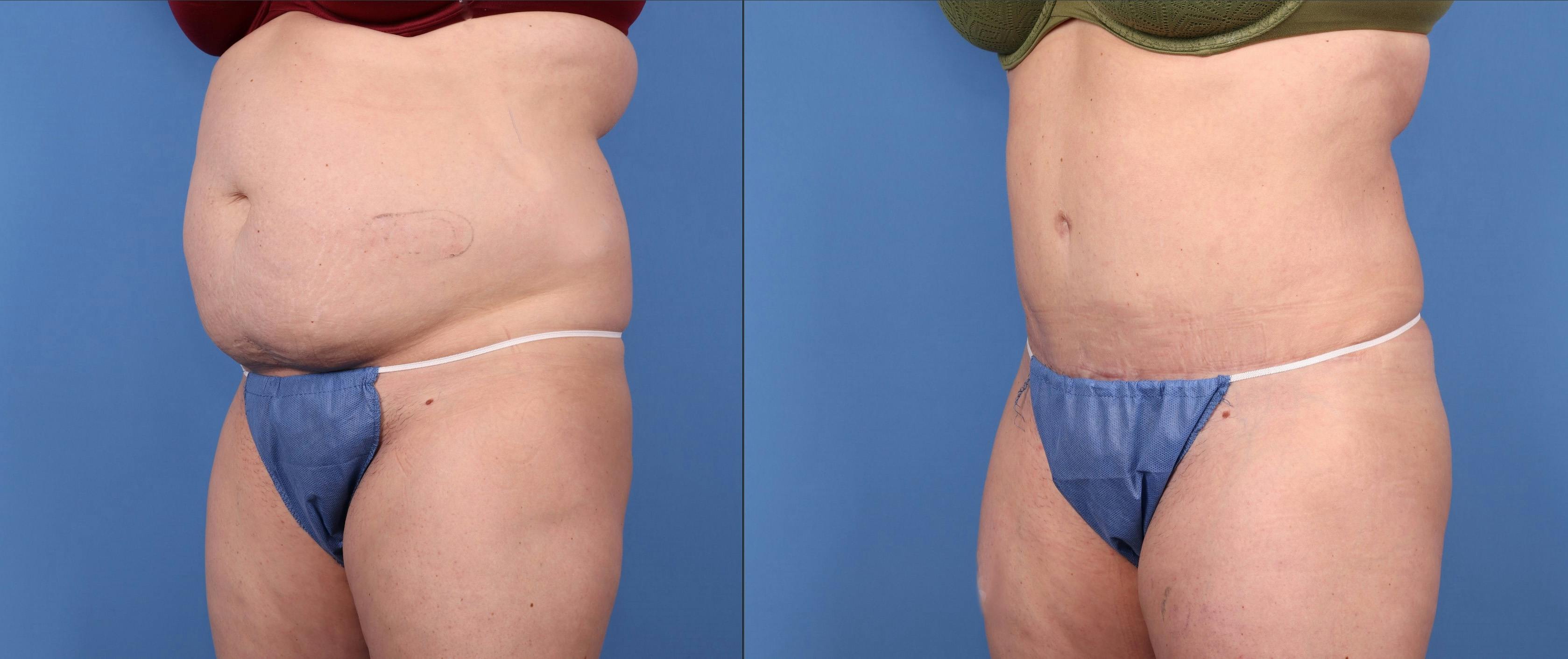 Tummy Tuck Before & After Gallery - Patient 146485000 - Image 2