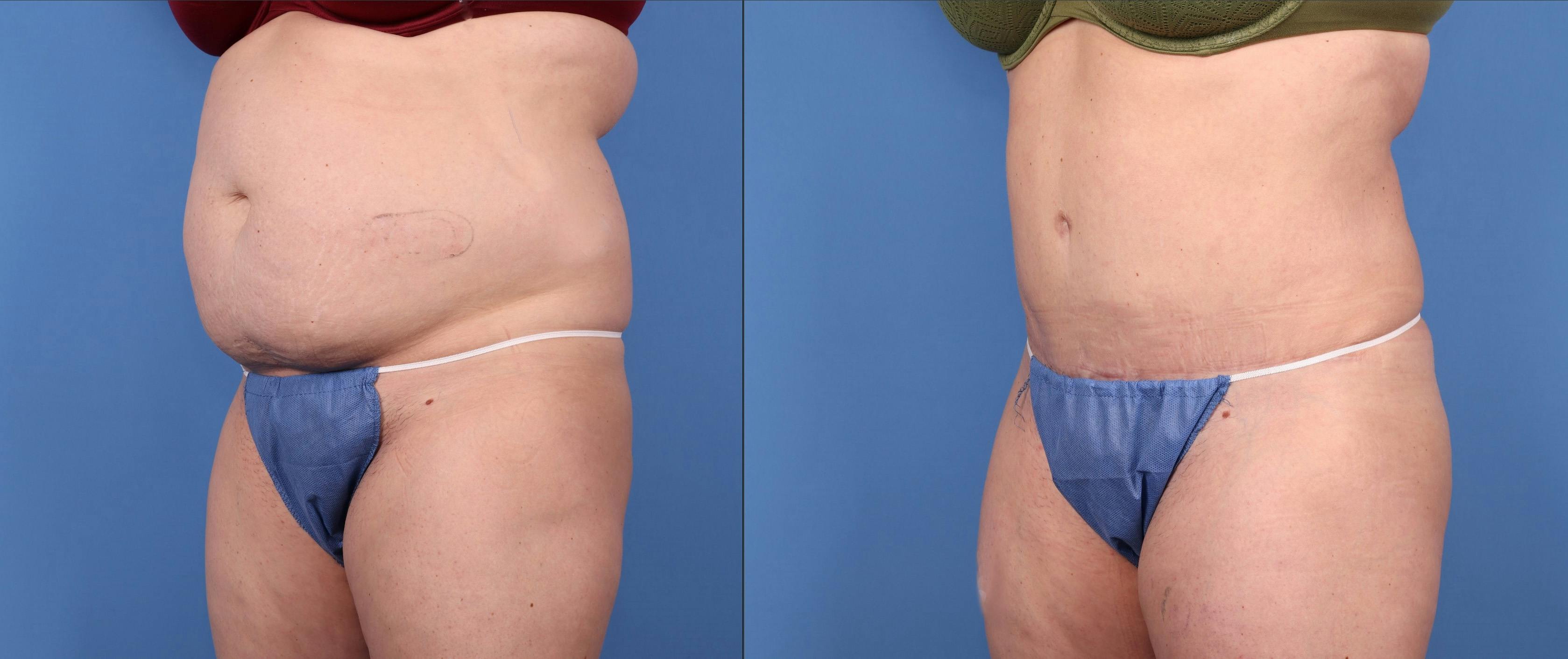 Abdomen Before & After Gallery - Patient 149385209 - Image 2