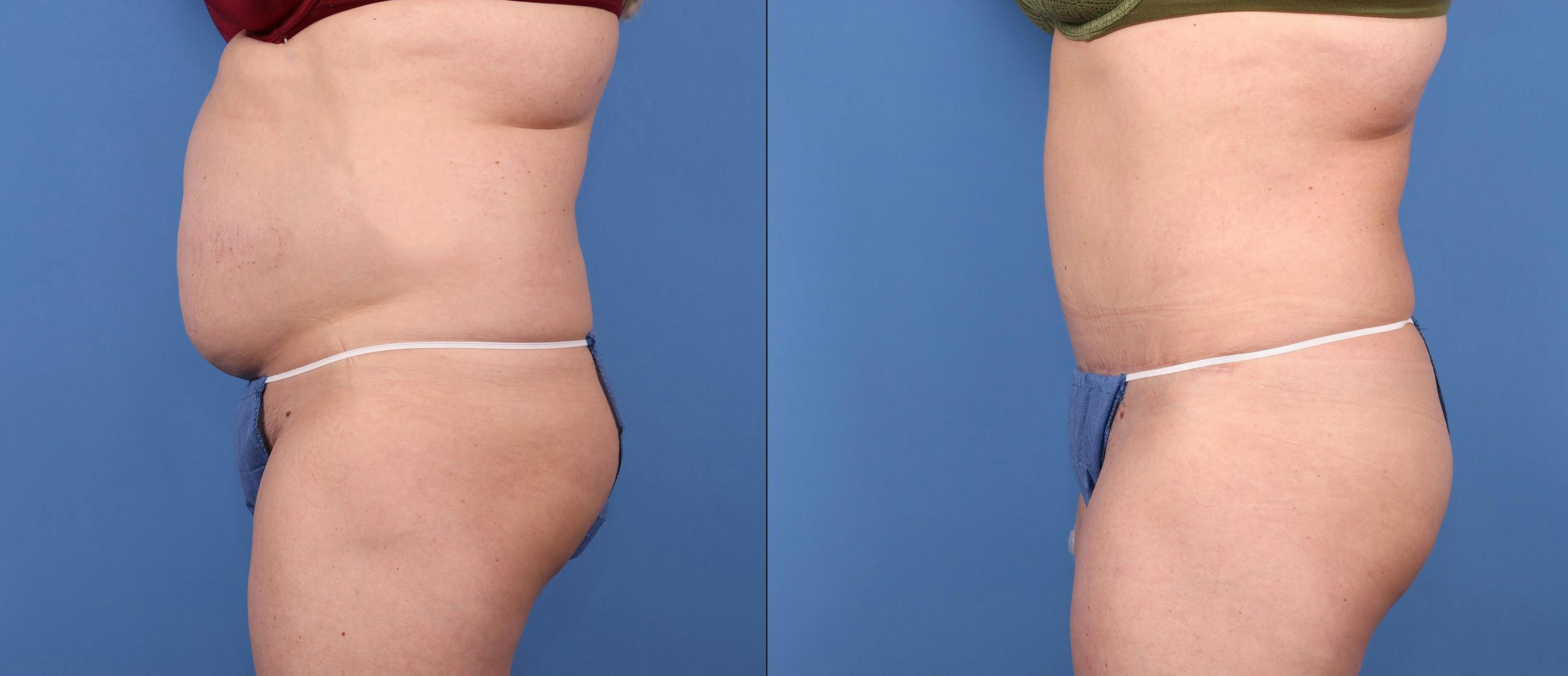 Abdomen Before & After Gallery - Patient 149385209 - Image 3