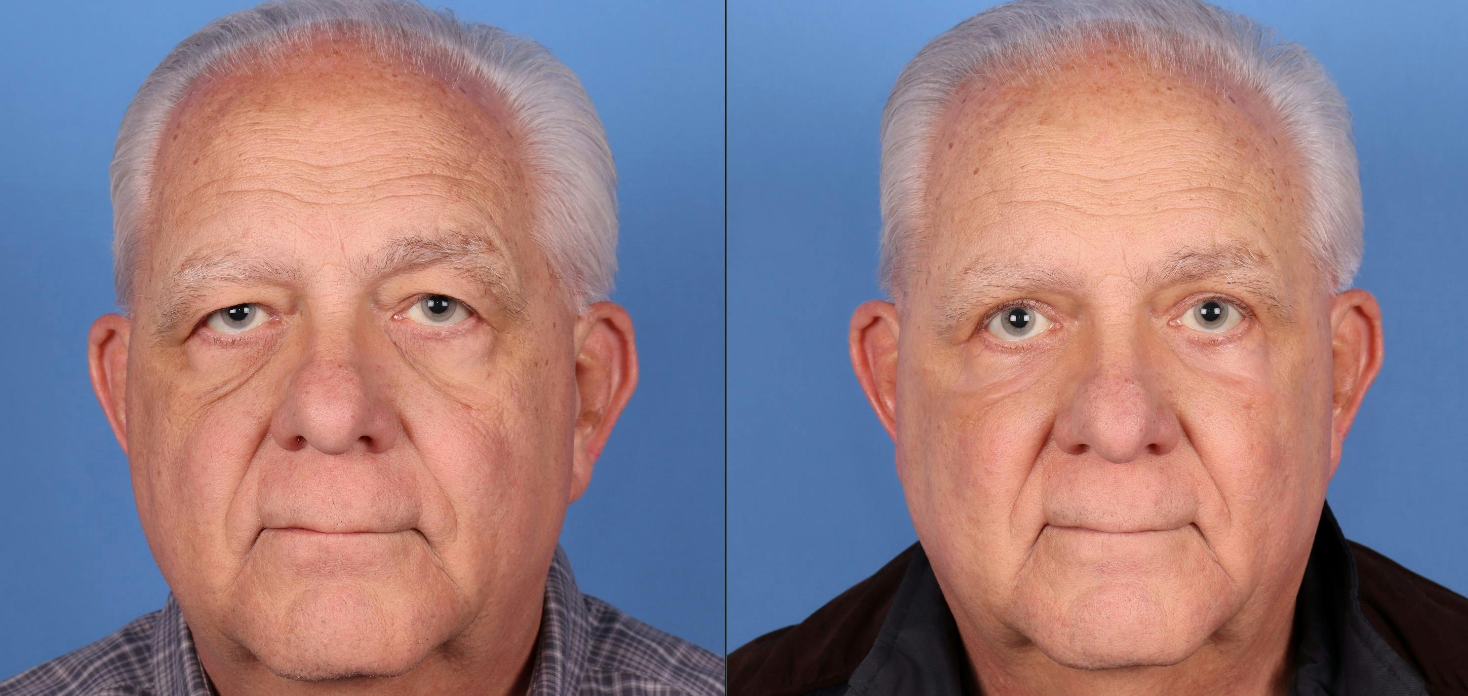 Eyelid Surgery (Blepharoplasty) Before & After Gallery - Patient 146485003 - Image 1