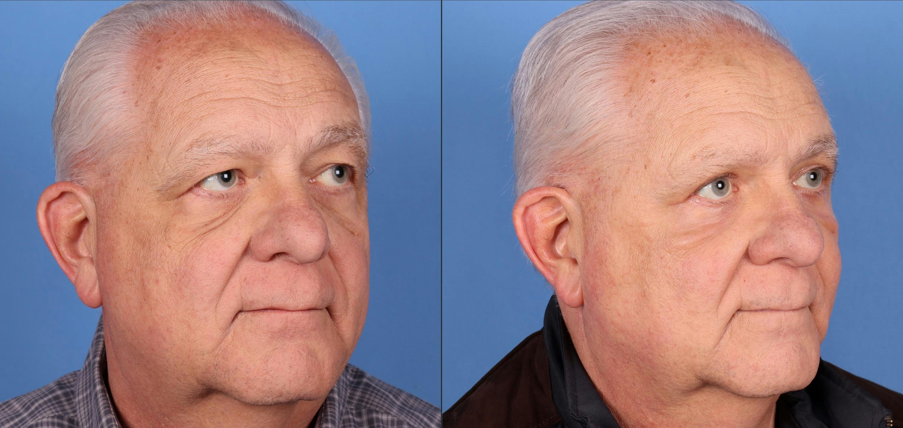 Contour TRL Laser Before & After Gallery - Patient 146485005 - Image 2