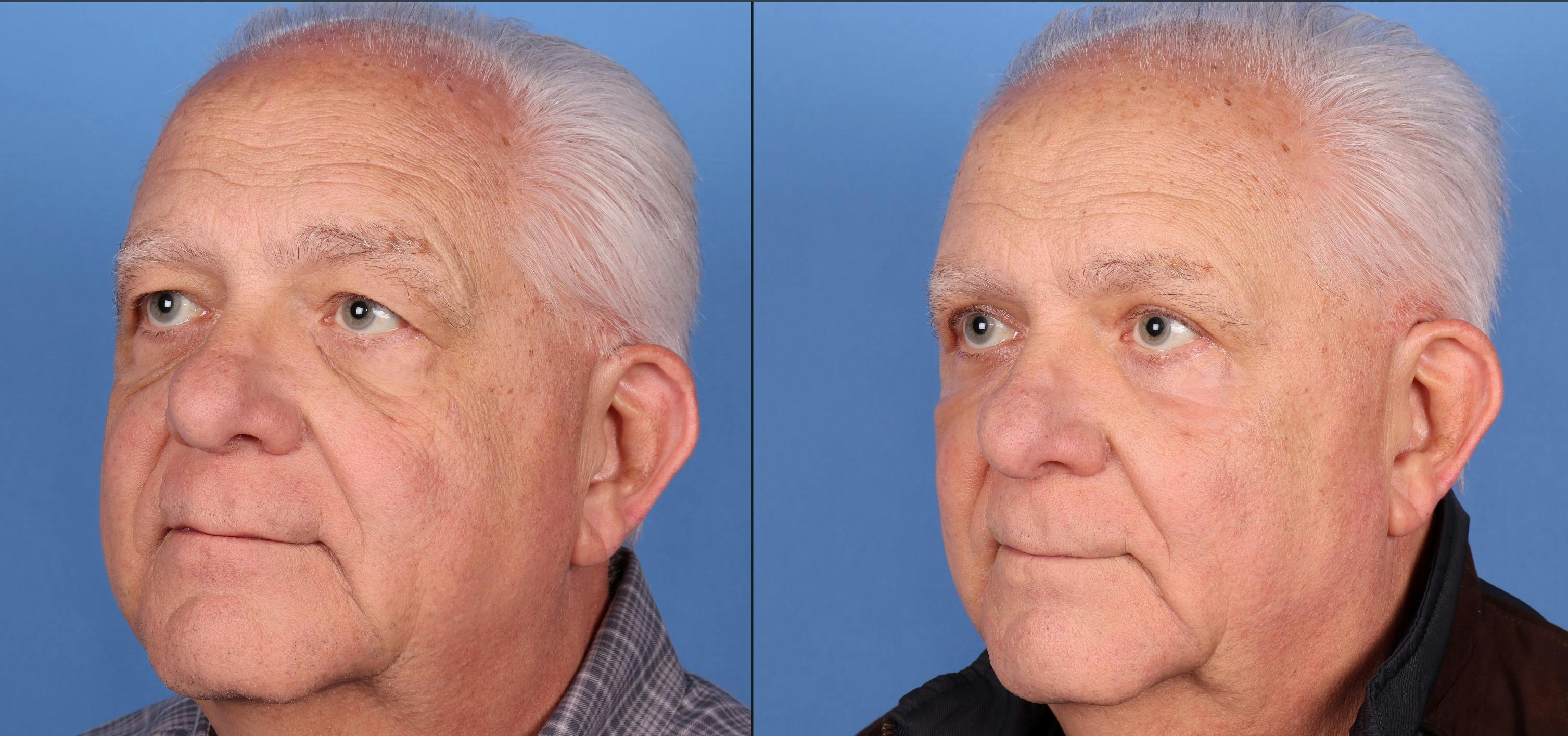 Eyelid Surgery (Blepharoplasty) Before & After Gallery - Patient 146485003 - Image 3