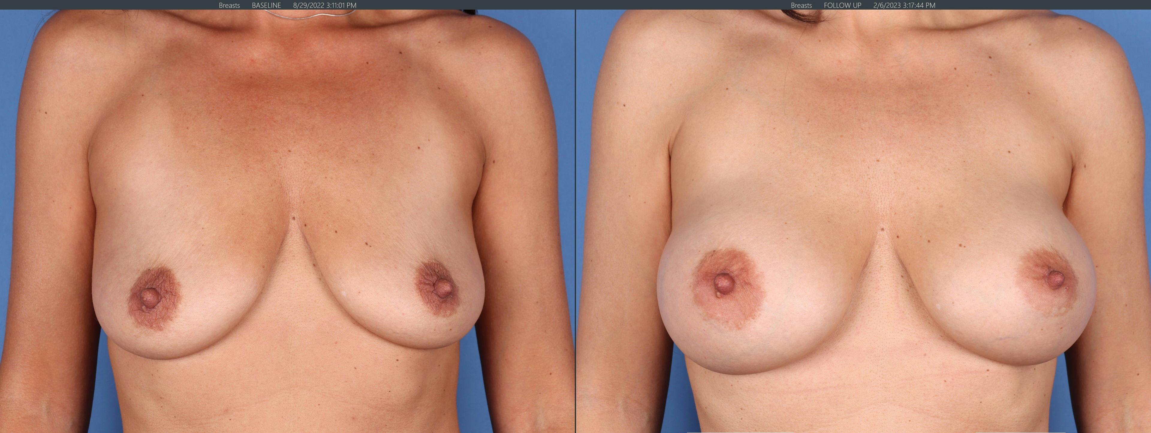 Breast Augmentation