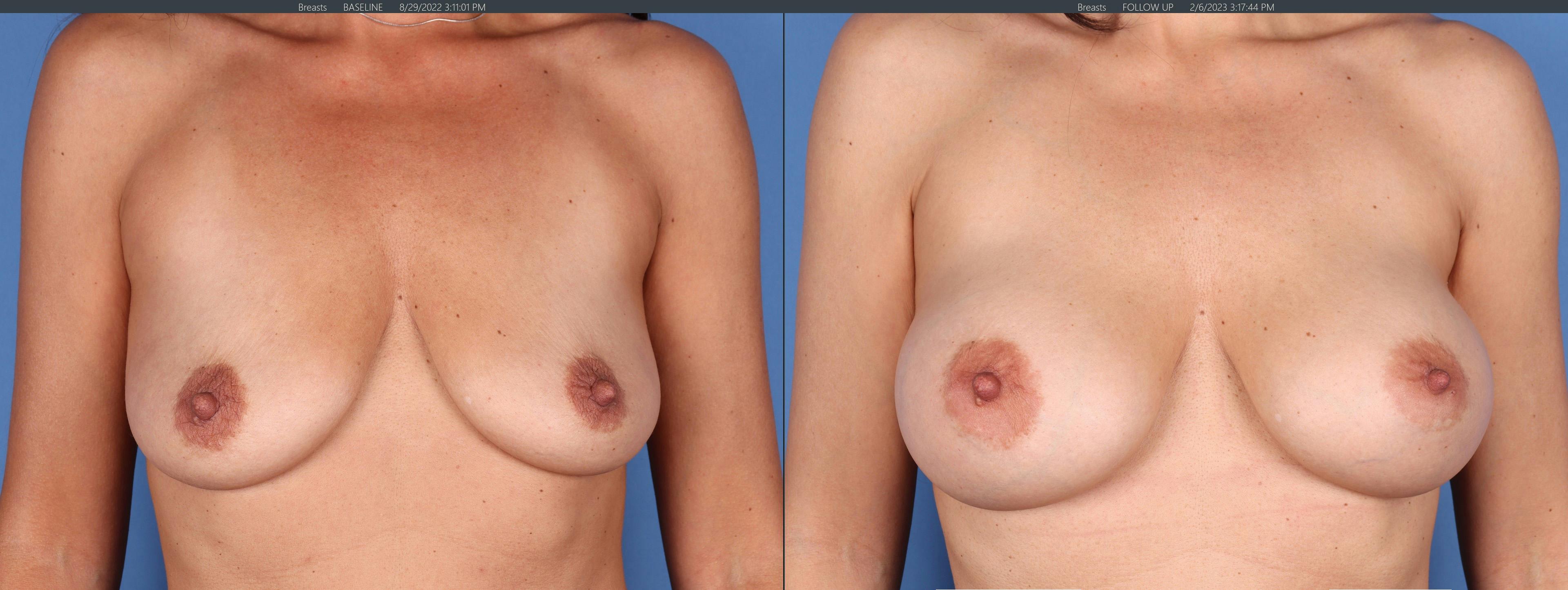 Breast Augmentation Before & After Gallery - Patient 146485007 - Image 1