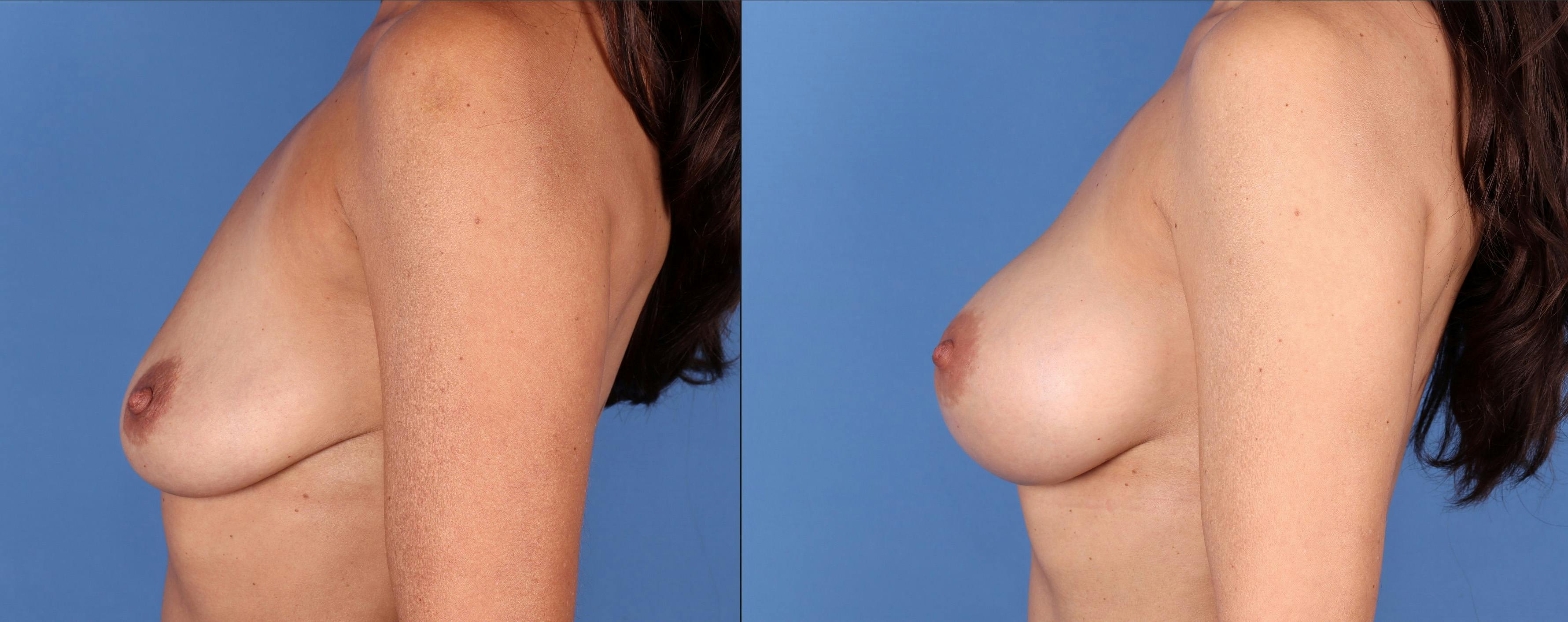 Breast Augmentation Before & After Gallery - Patient 146485007 - Image 3