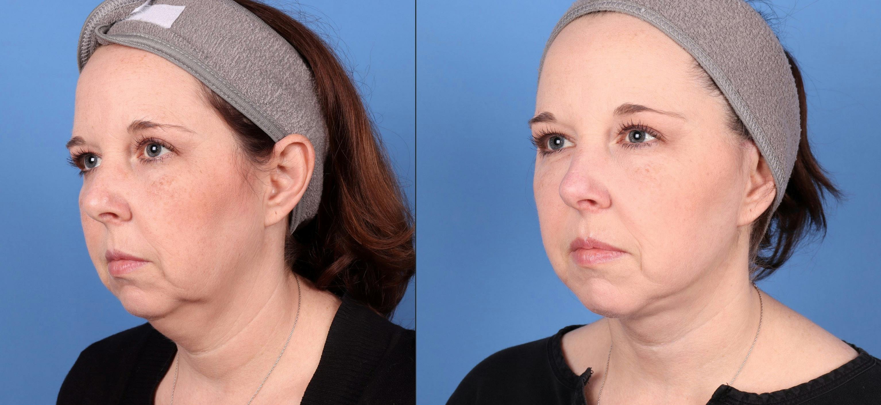 Neck Lift Before & After Gallery - Patient 146485011 - Image 2