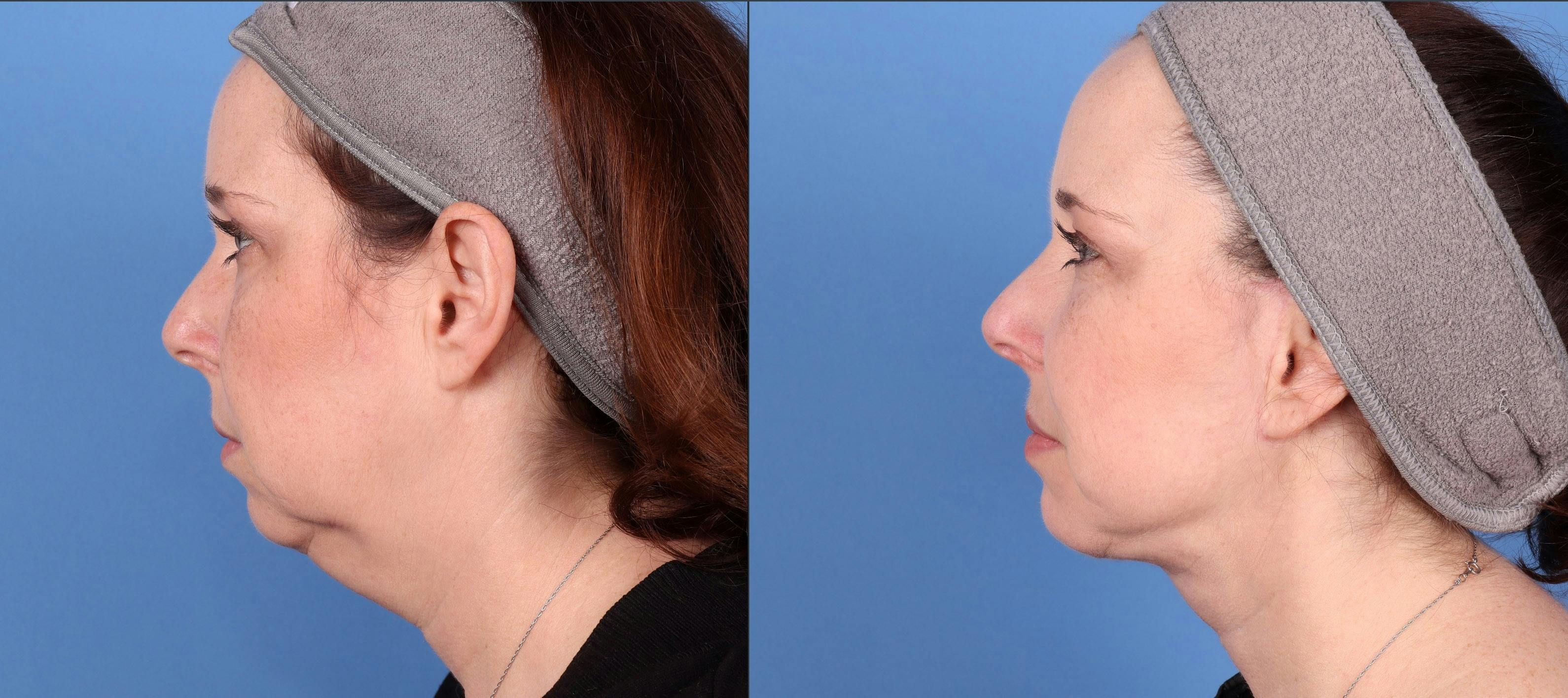 Neck Lift Before & After Gallery - Patient 146485011 - Image 1