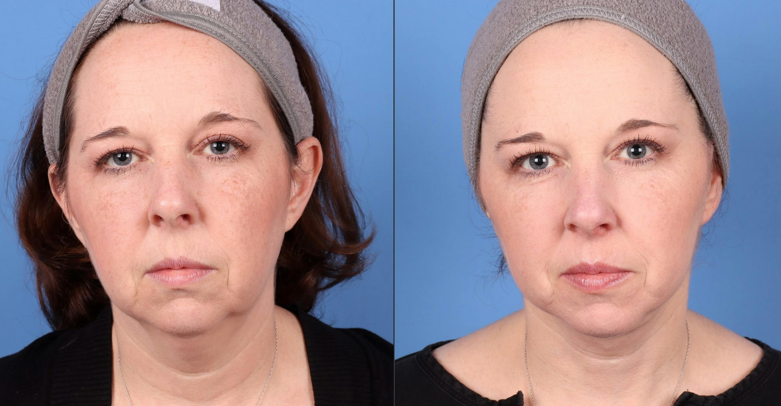 Face Lift Before & After Gallery - Patient 146485010 - Image 1