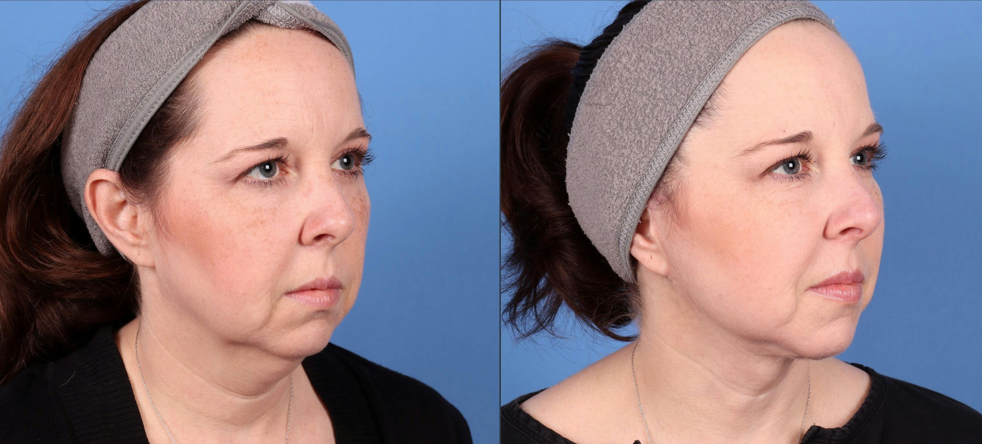 Neck Lift Before & After Gallery - Patient 146485011 - Image 4