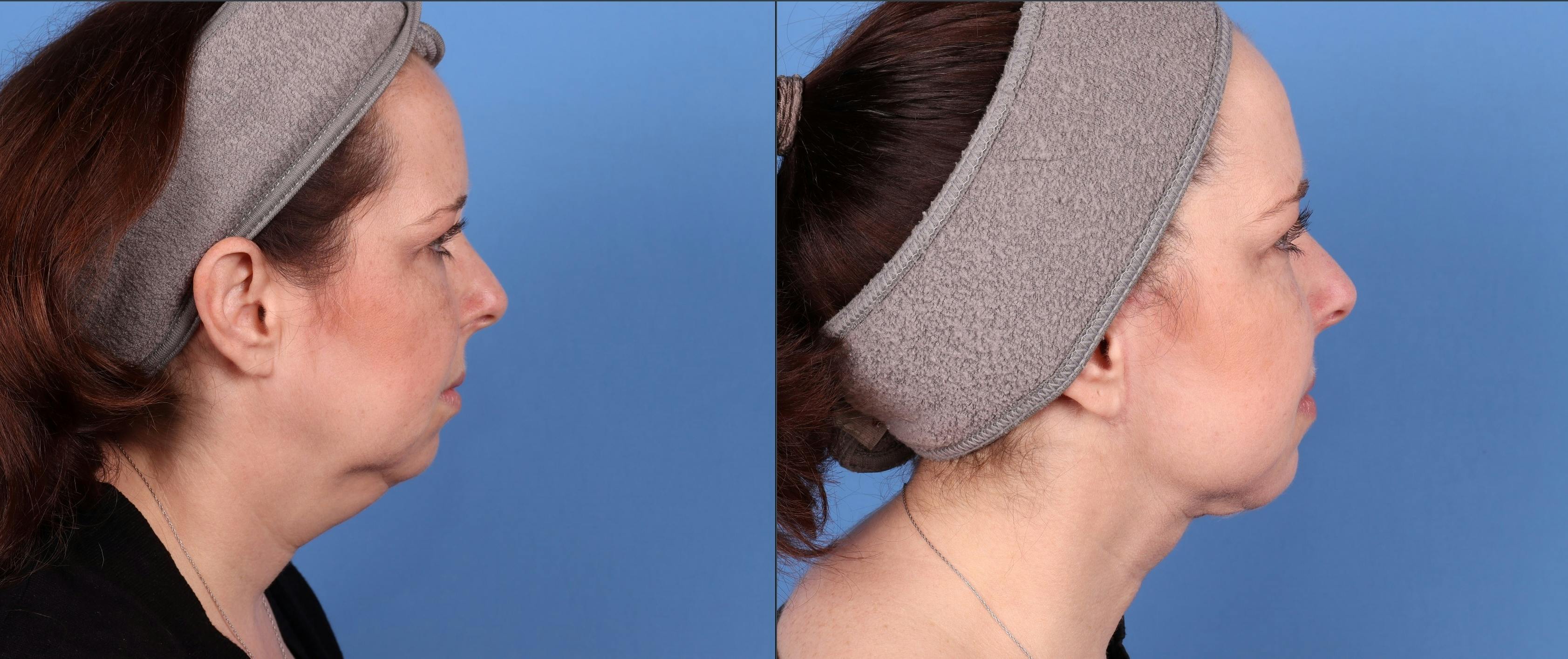 Neck Lift Before & After Gallery - Patient 146485011 - Image 5