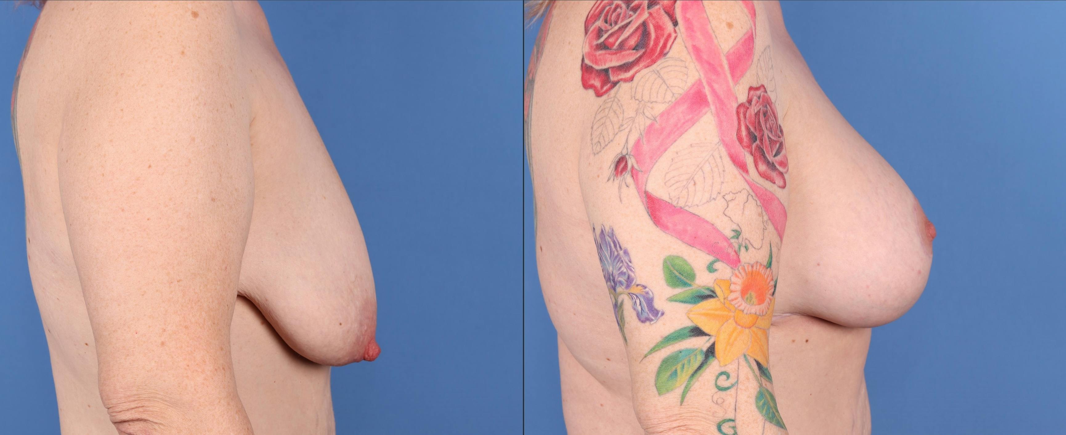 Liposuction Before & After Gallery - Patient 146485070 - Image 6