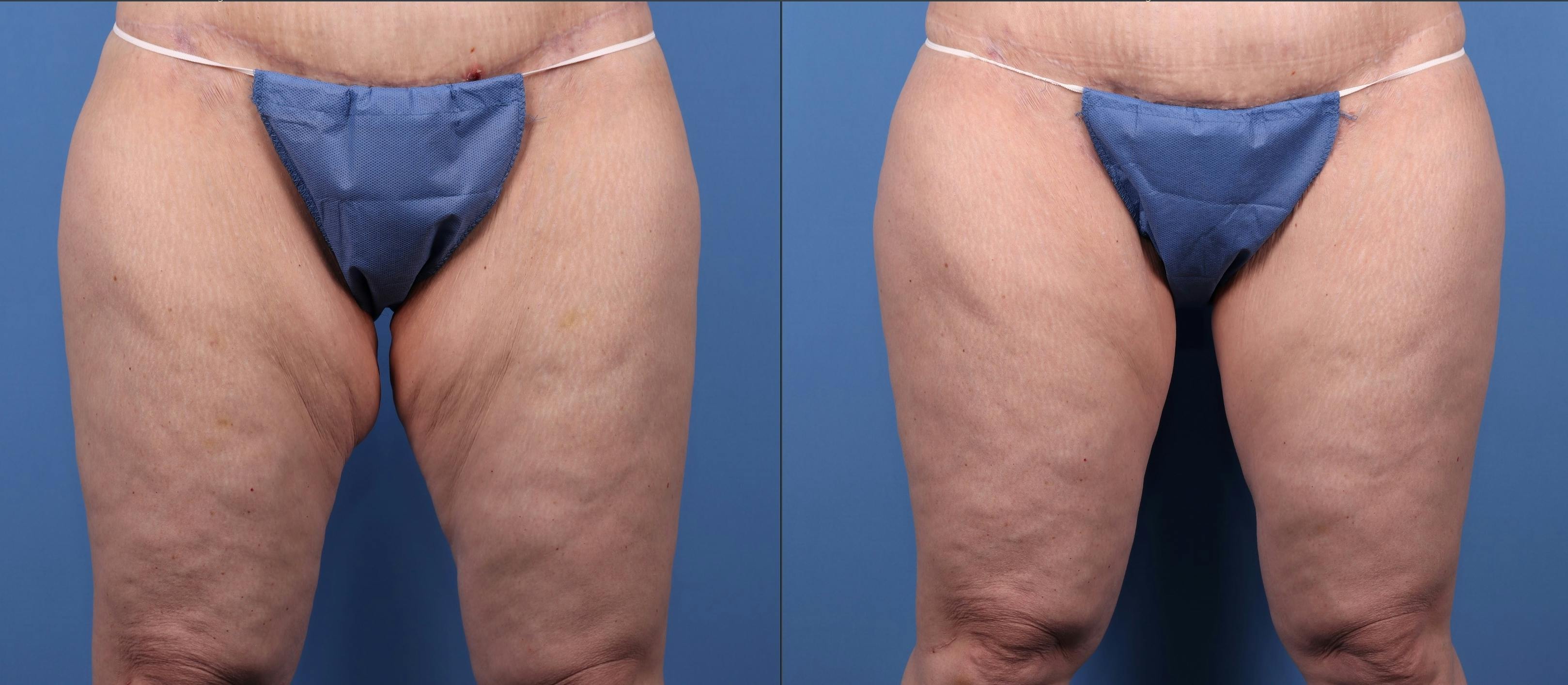 Thighs Before & After Gallery - Patient 149385426 - Image 1