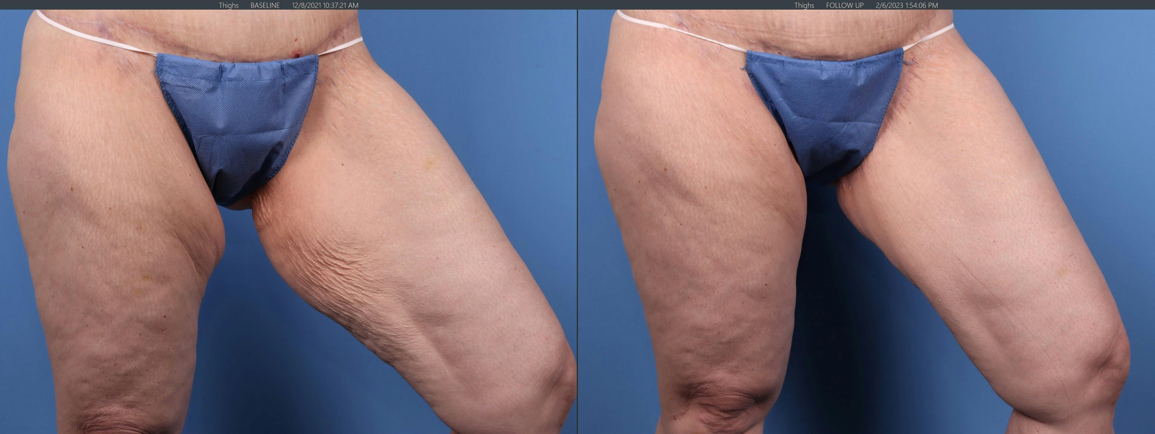 Liposuction Before & After Gallery - Patient 146485070 - Image 2