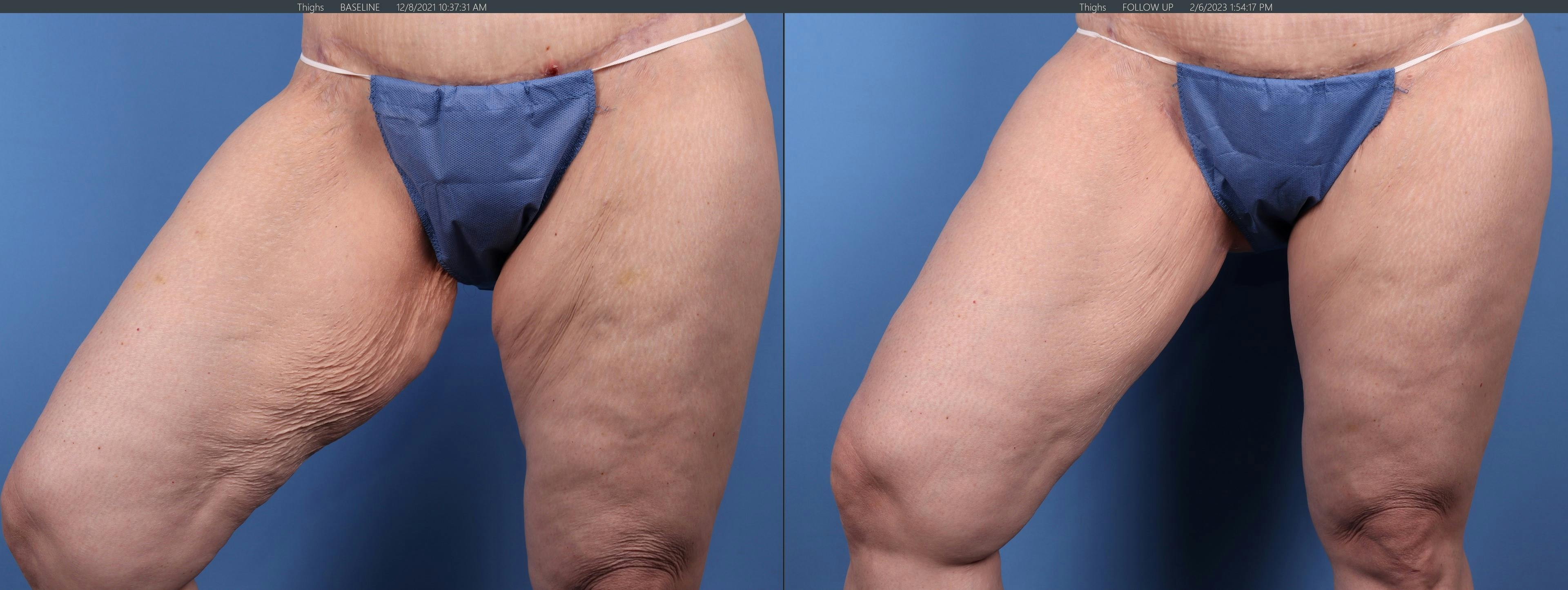 Liposuction Before & After Gallery - Patient 146485070 - Image 3