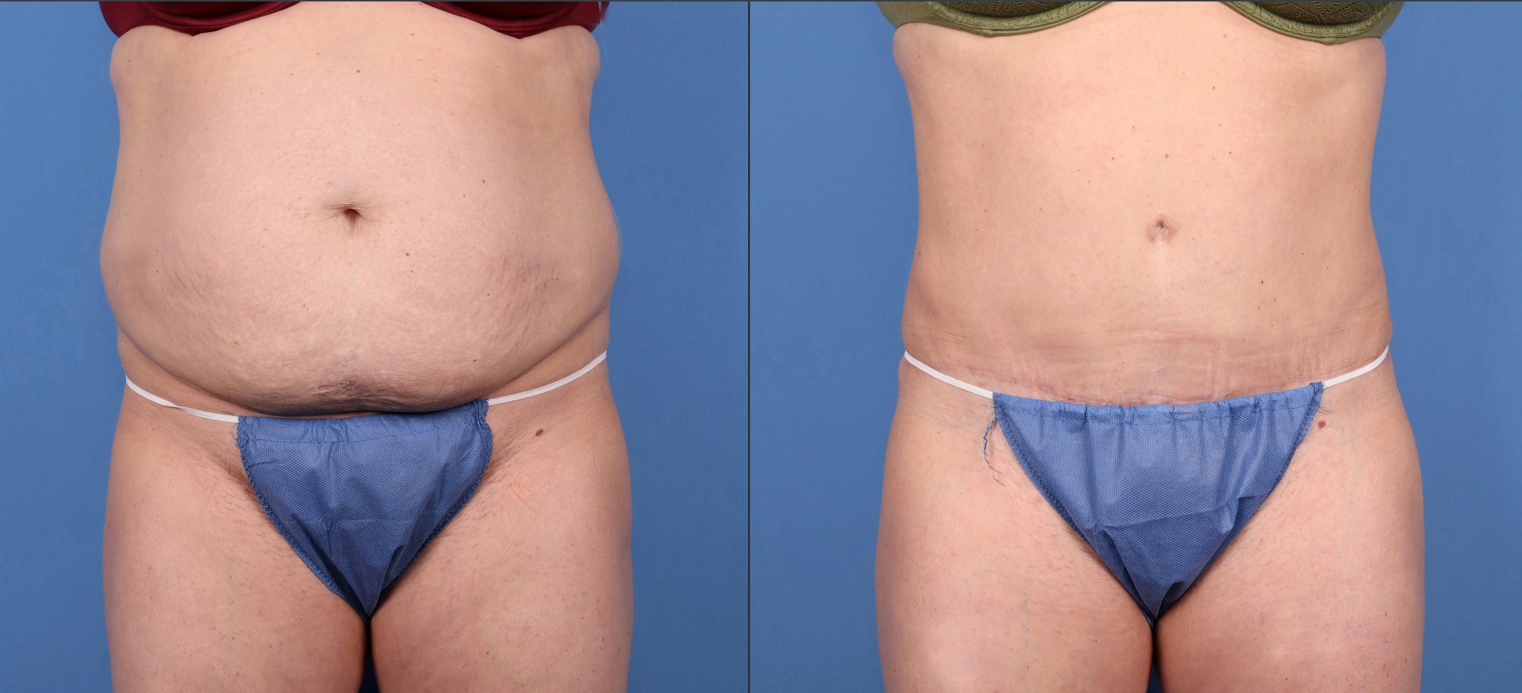 Tummy Tuck Before & After Gallery - Patient 146485000 - Image 1