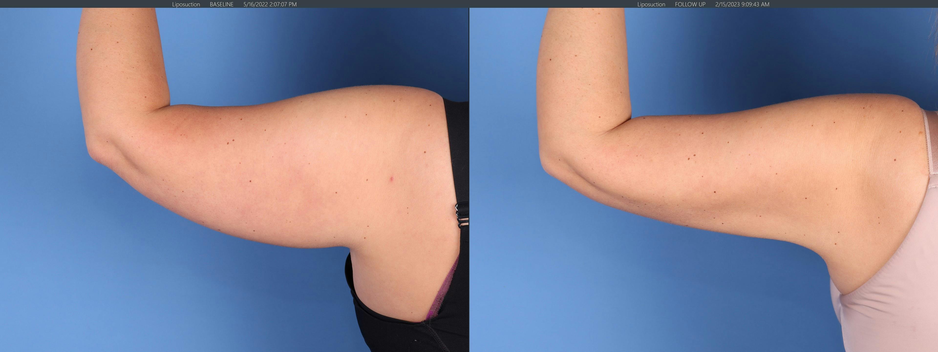 Arms Before & After Gallery - Patient 149385360 - Image 1