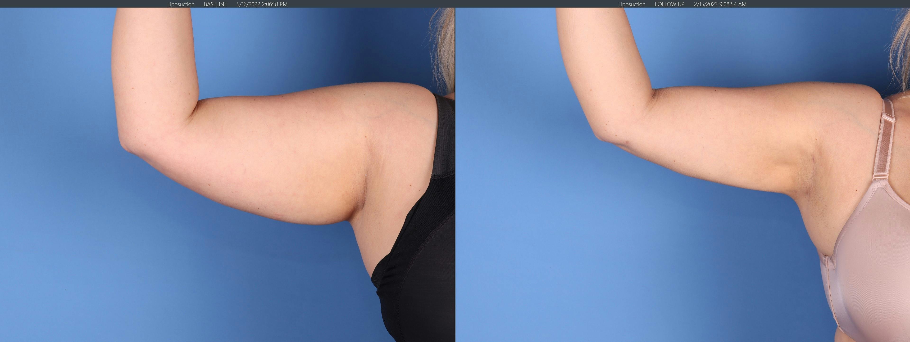 Liposuction Before & After Gallery - Patient 146559295 - Image 2