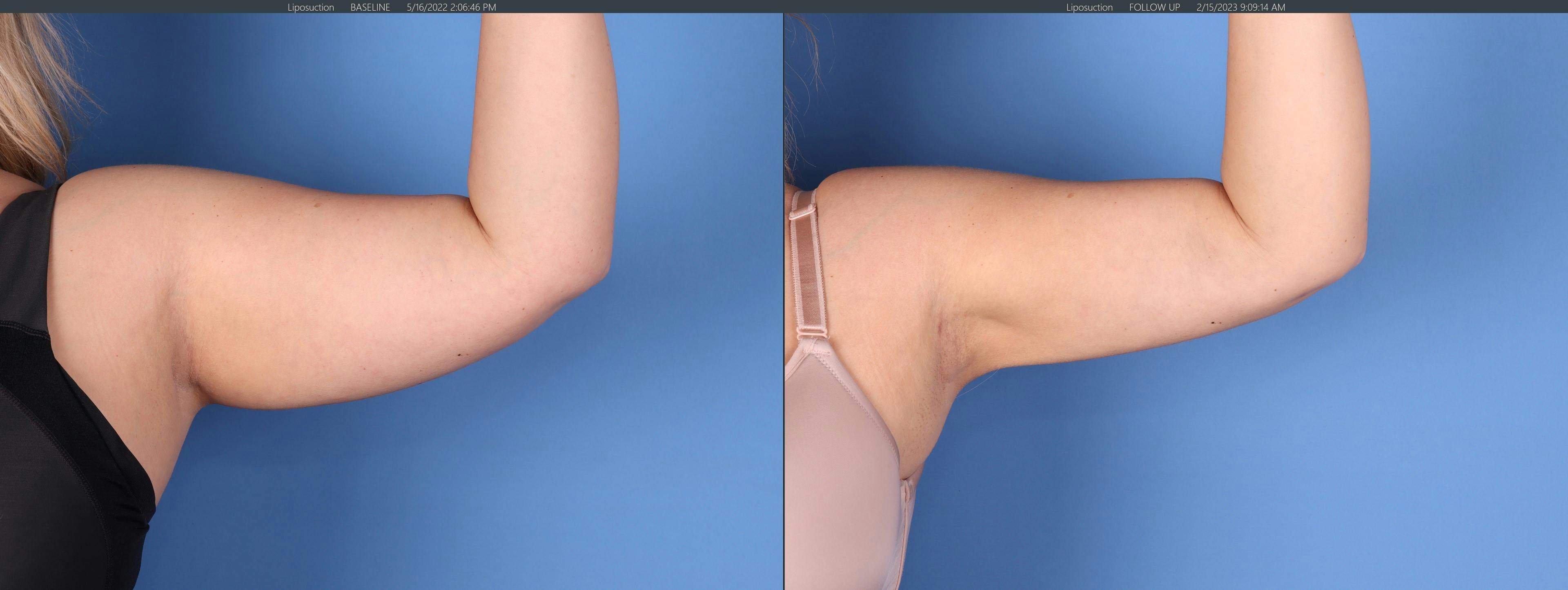 Arms Before & After Gallery - Patient 149385360 - Image 3