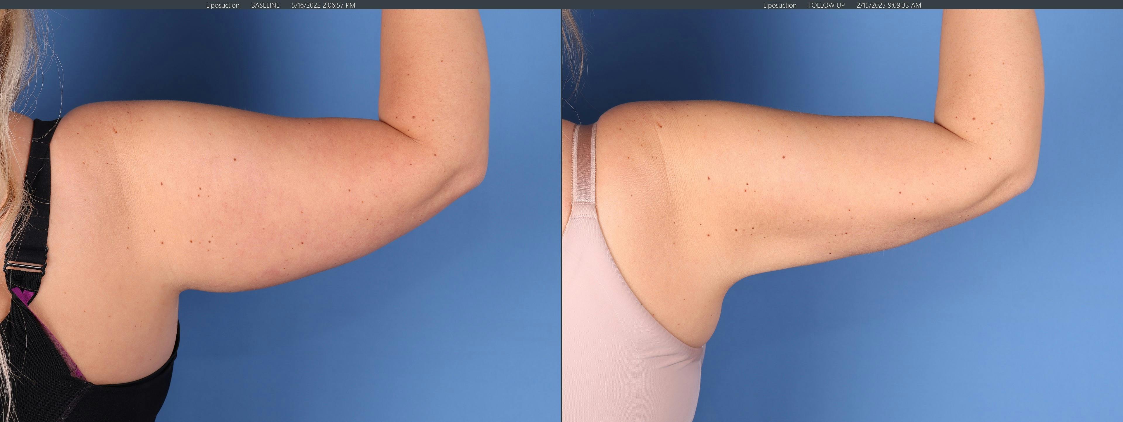 Liposuction Before & After Gallery - Patient 146559295 - Image 4