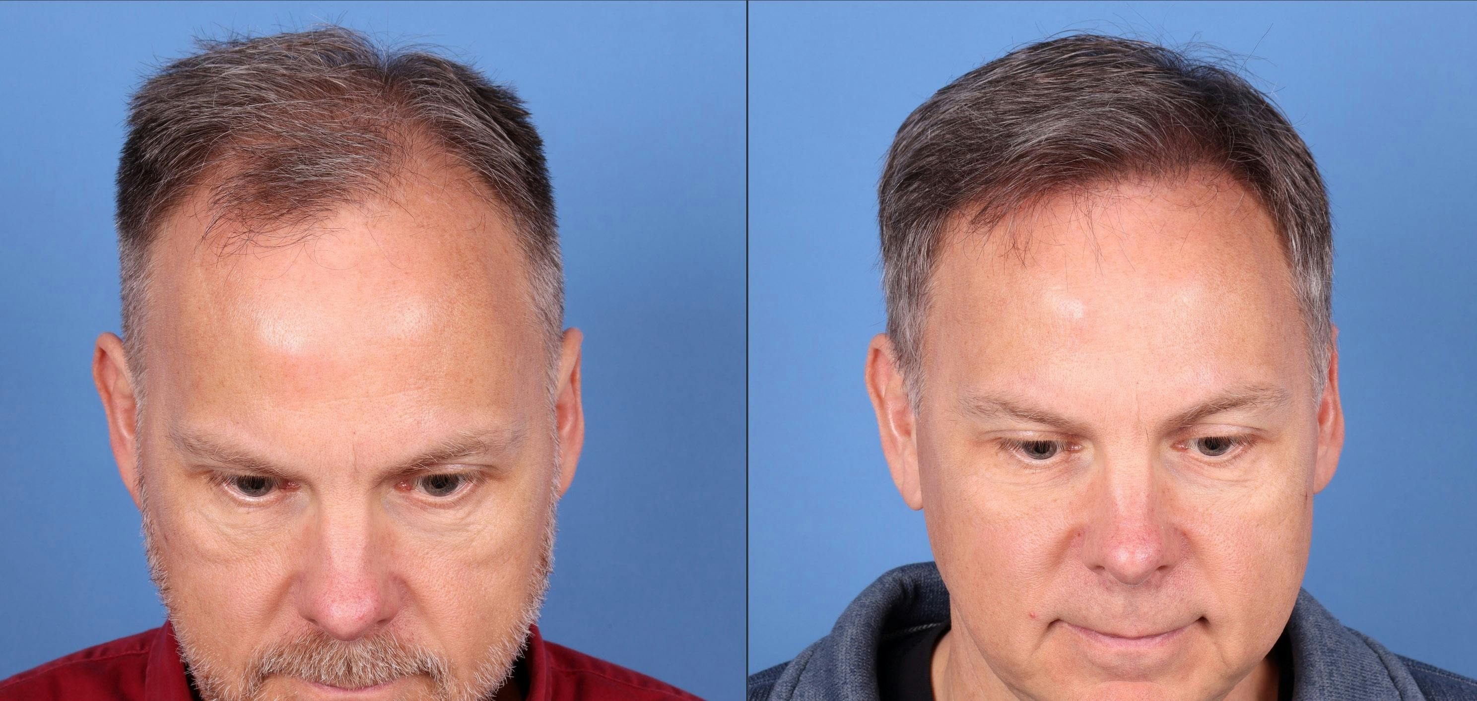 NeoGraft Hair Restoration Before & After Gallery - Patient 146621448 - Image 1