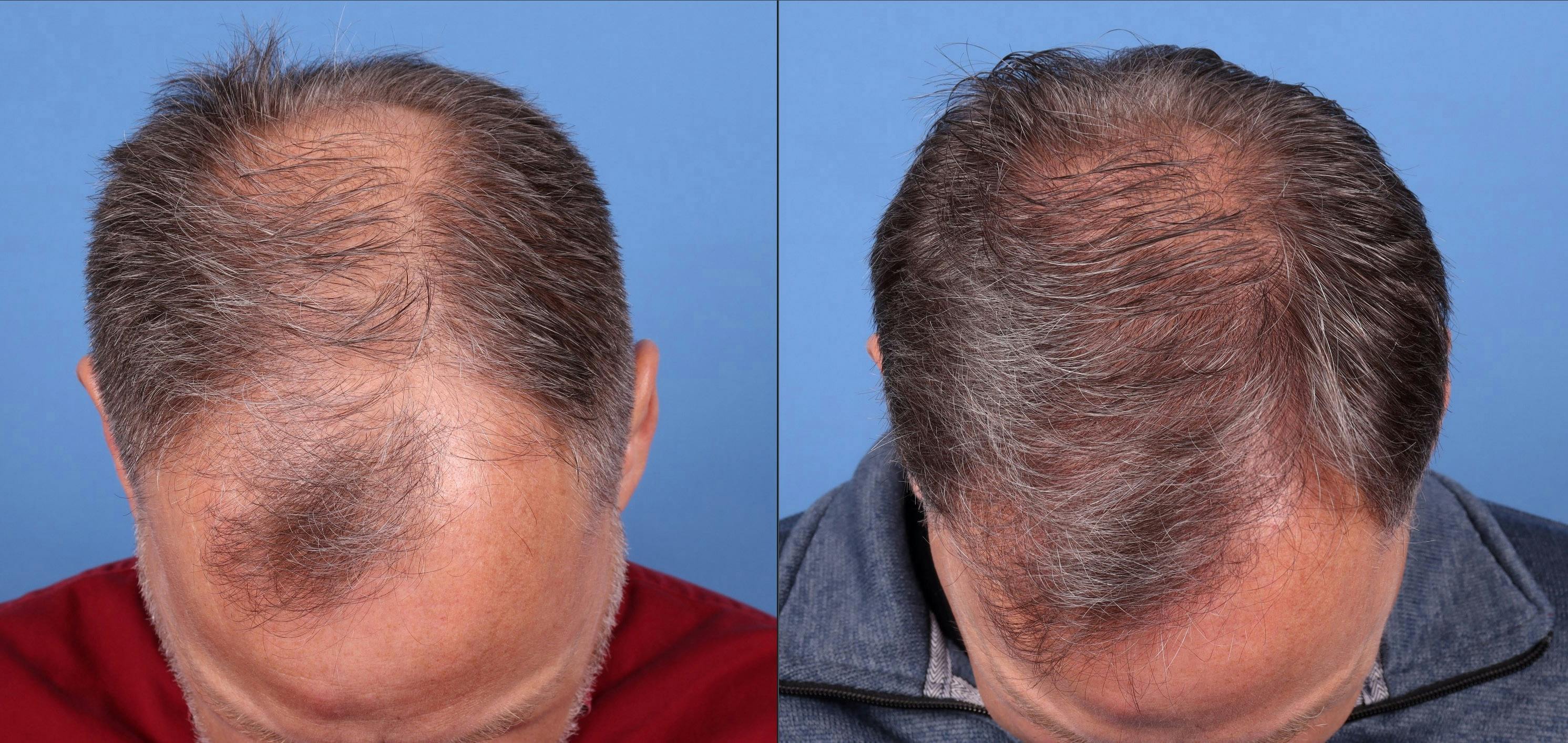 NeoGraft Hair Restoration Before & After Gallery - Patient 146621448 - Image 2