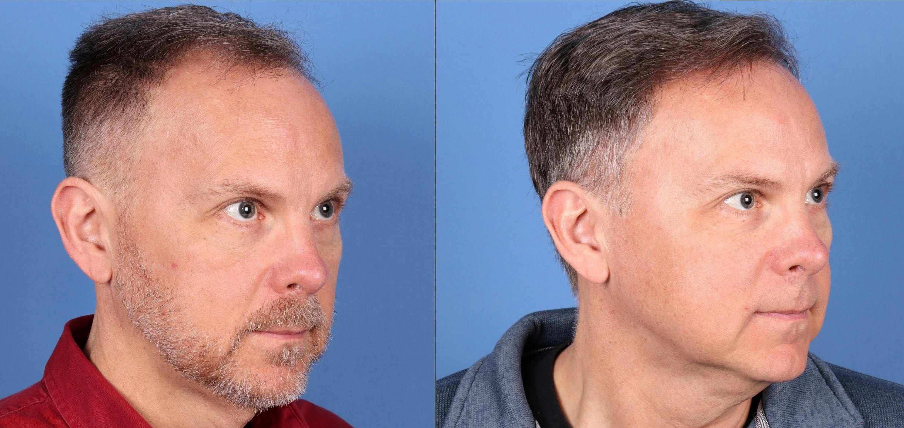 NeoGraft Hair Restoration Before & After Gallery - Patient 146621448 - Image 3