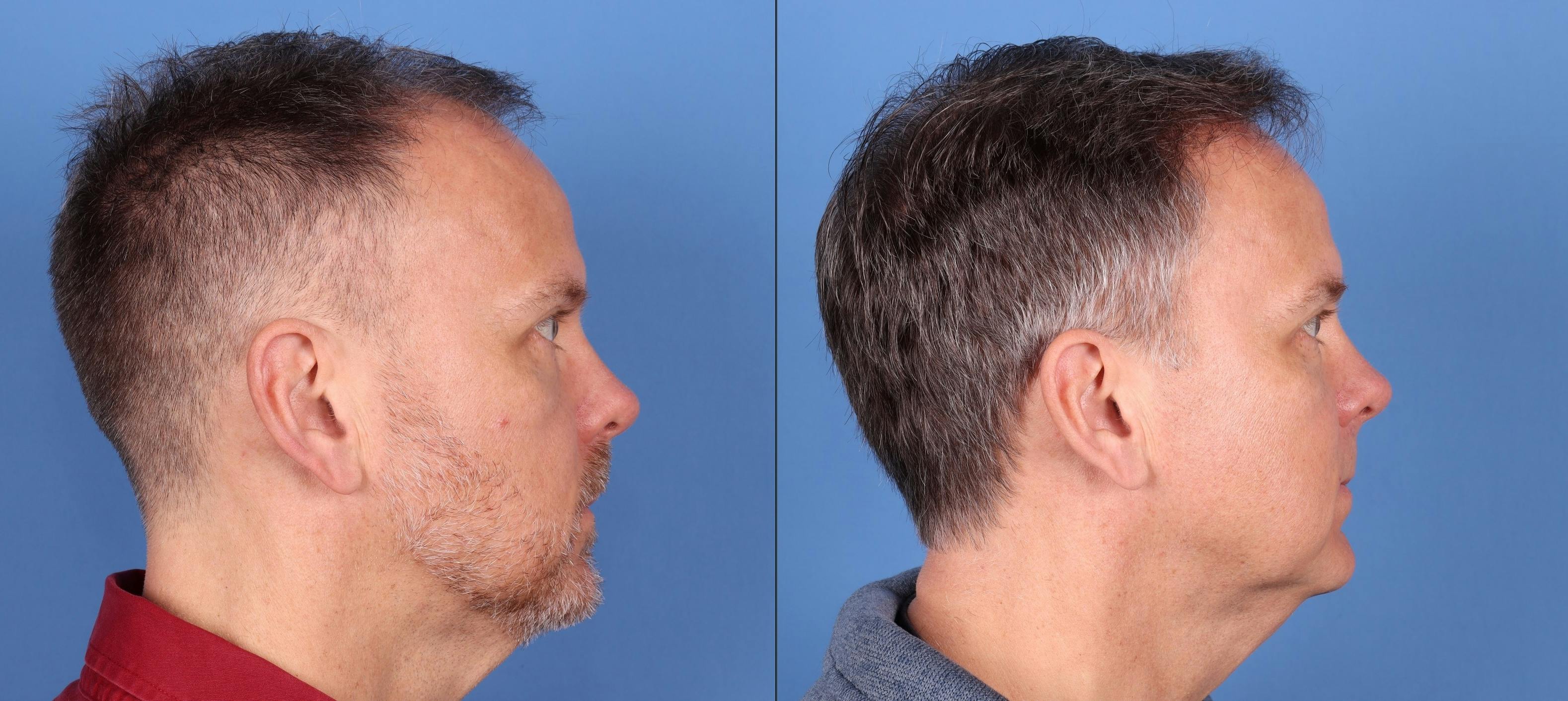 NeoGraft Hair Restoration Before & After Gallery - Patient 146621448 - Image 4