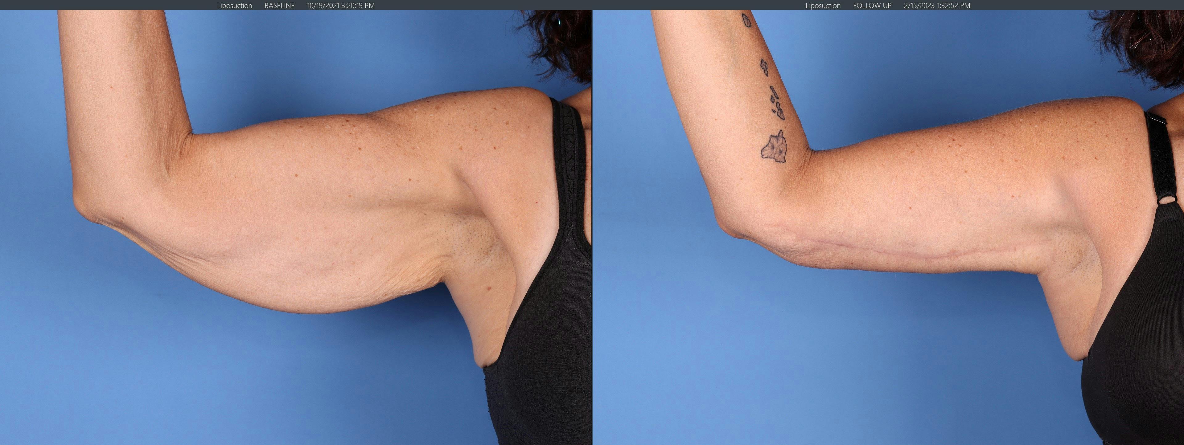 Arm Lift Before & After Gallery - Patient 146621585 - Image 2