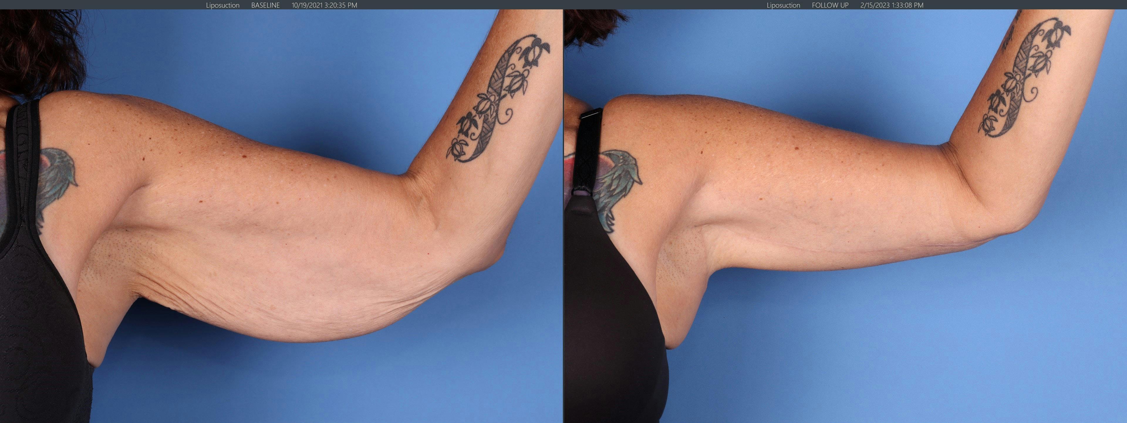 Arm Lift Before & After Gallery - Patient 452679 - Image 3
