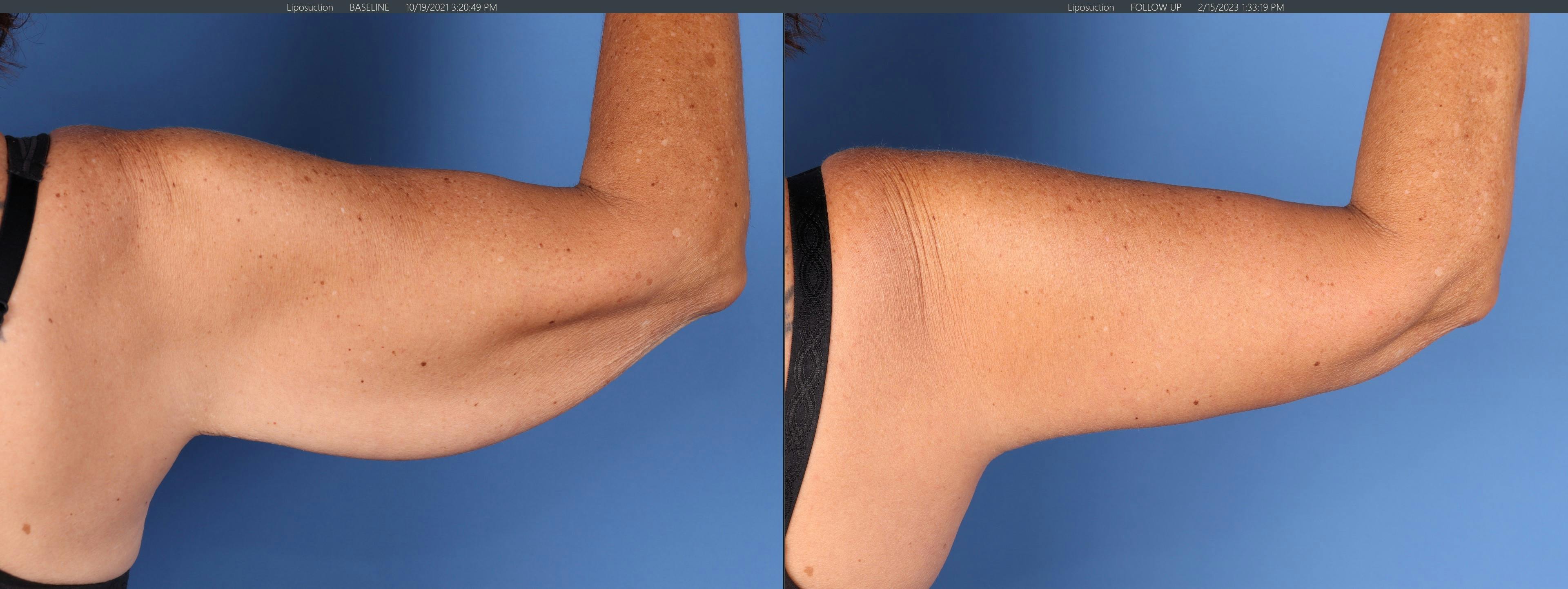 Arm Lift Before & After Gallery - Patient 452679 - Image 4
