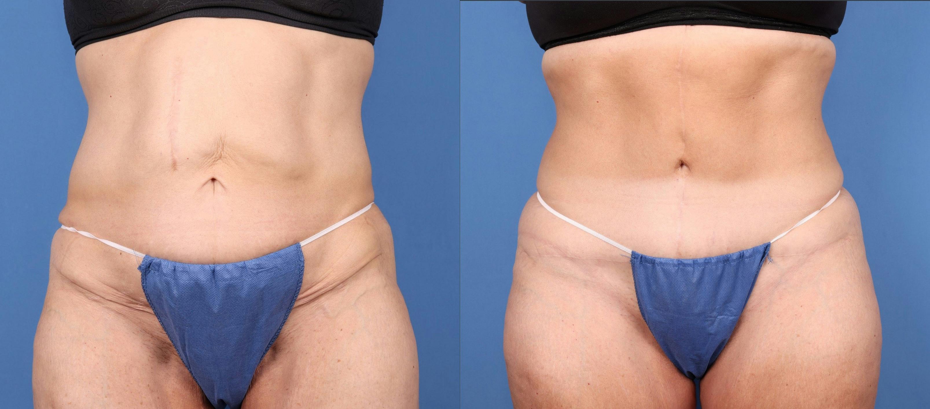Tummy Tuck Before & After Gallery - Patient 146621587 - Image 1