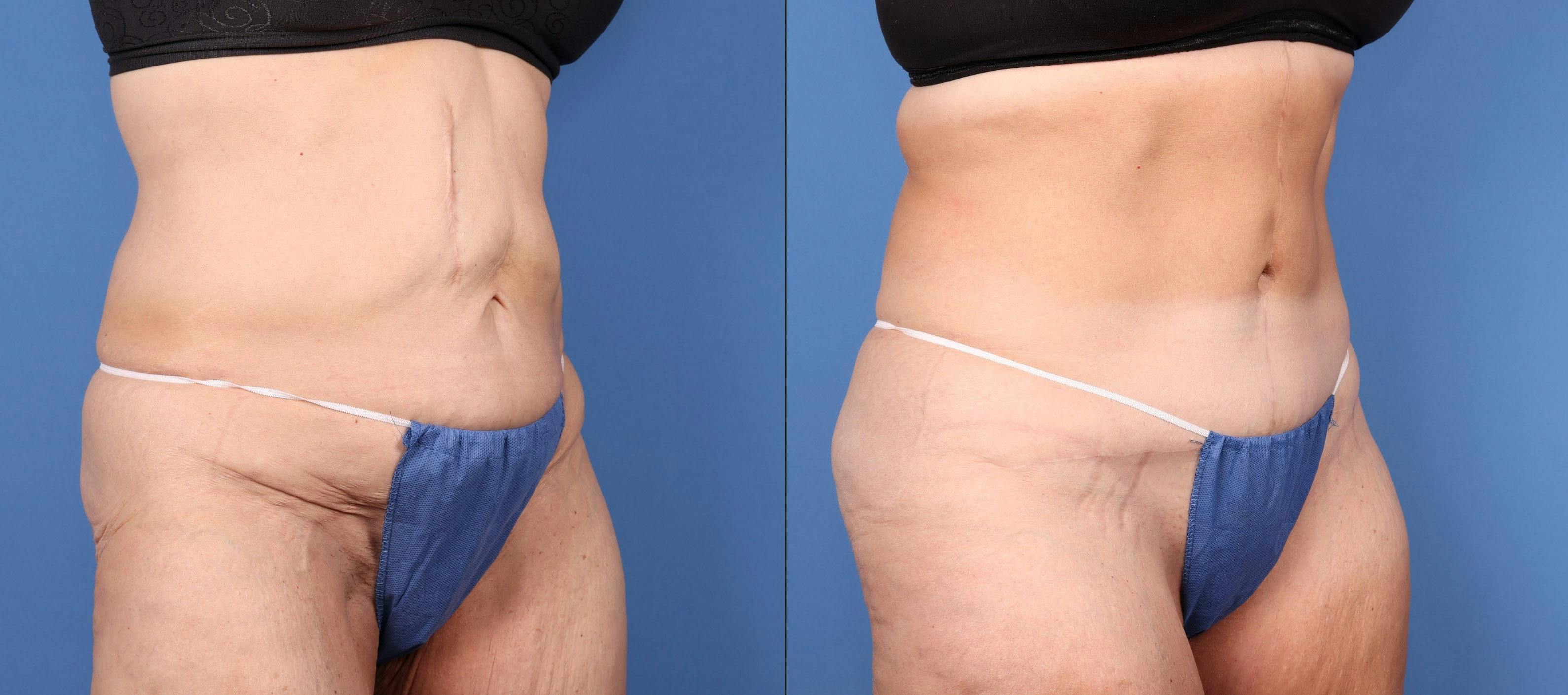 Body Lift Before & After Gallery - Patient 146621586 - Image 2