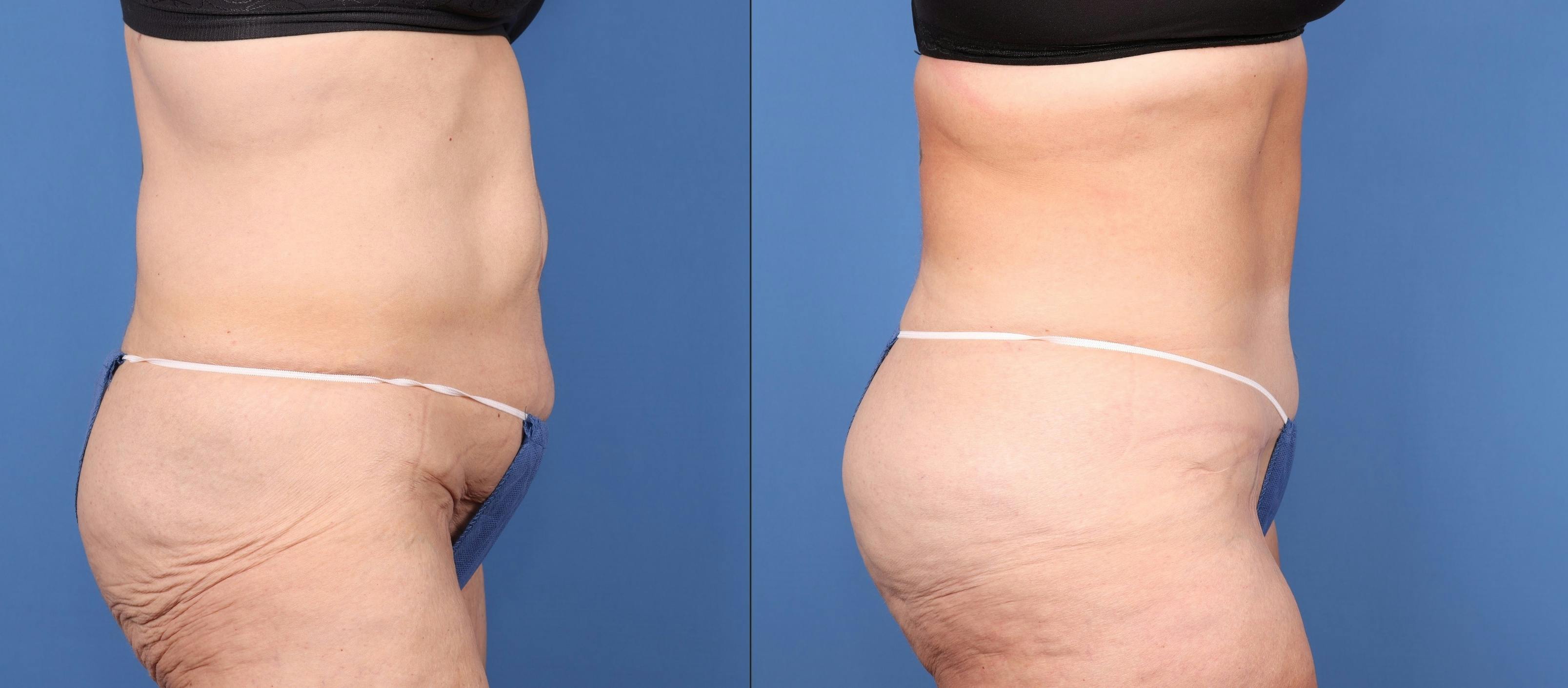 Tummy Tuck Before & After Gallery - Patient 146621587 - Image 3
