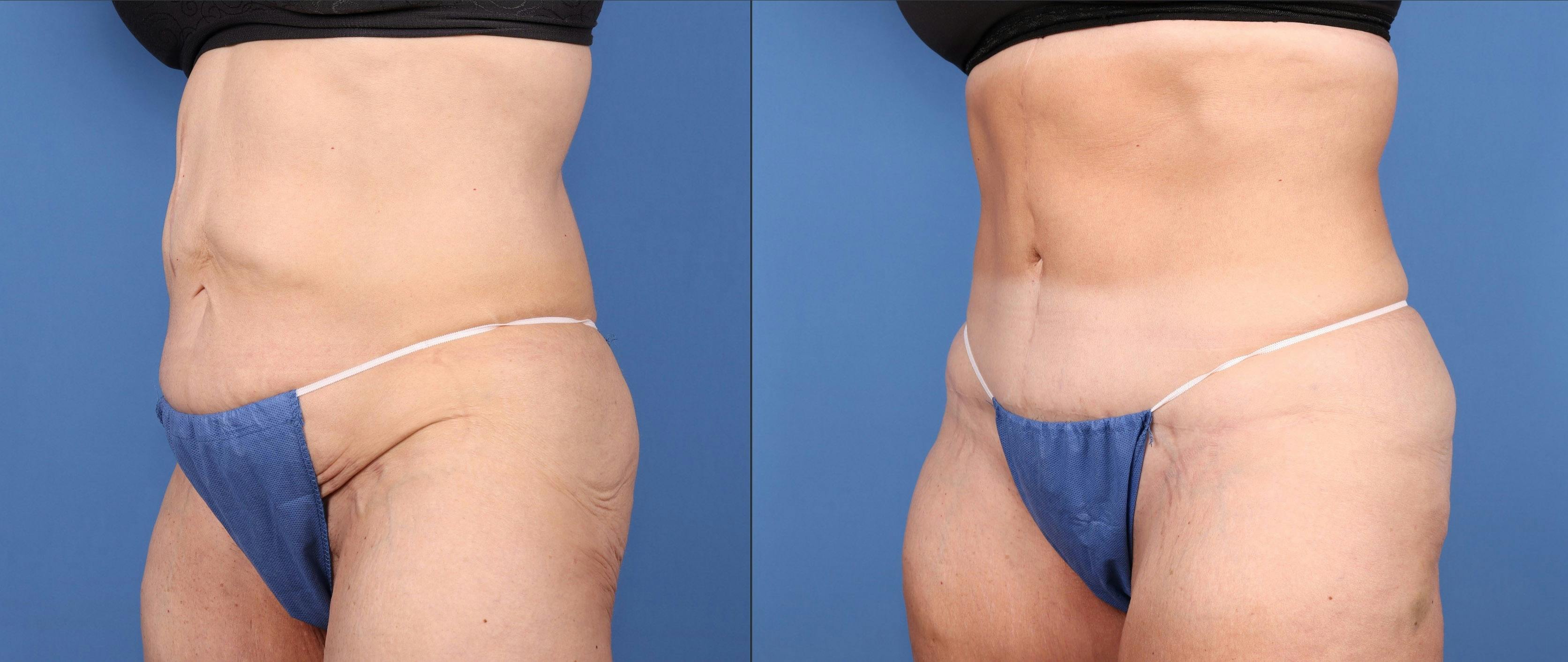 Tummy Tuck Before & After Gallery - Patient 146621587 - Image 4