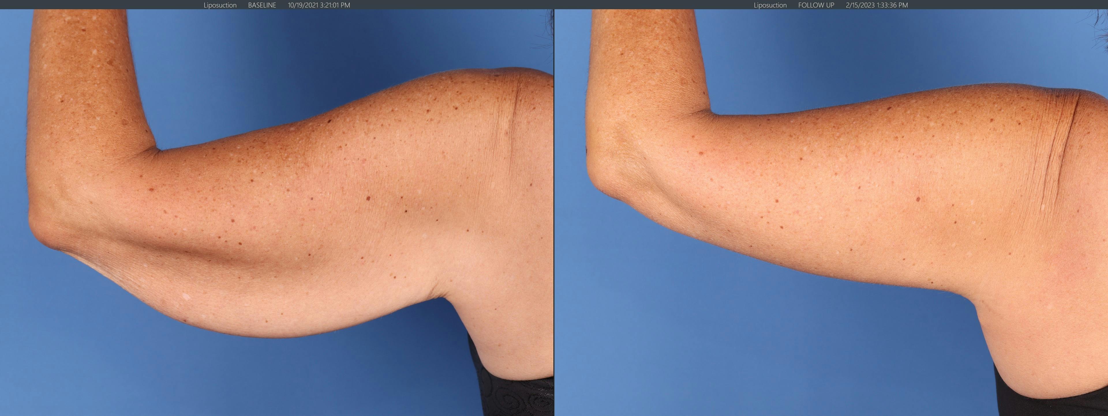 Arm Lift Before & After Gallery - Patient 146621585 - Image 1