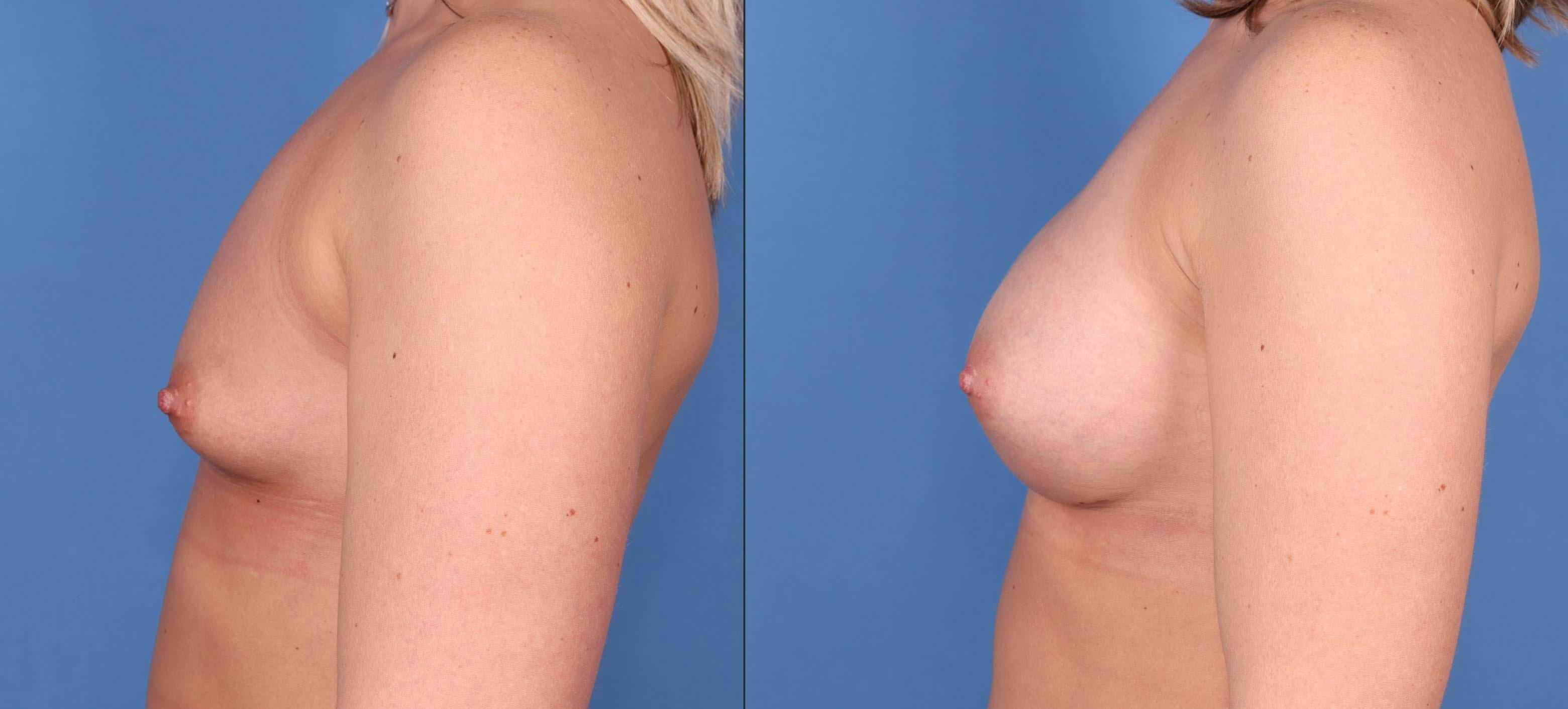 Breast Augmentation Before & After Gallery - Patient 146753386 - Image 5
