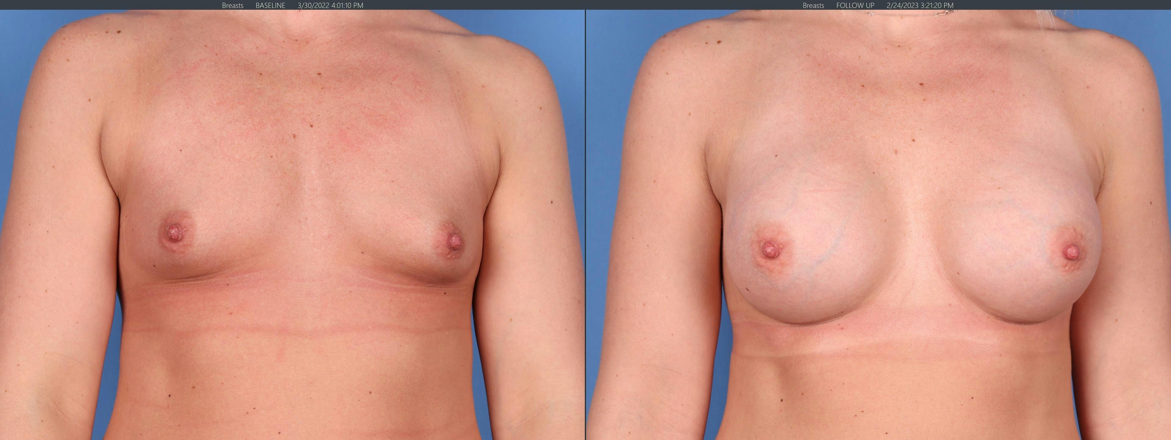 Breast Augmentation Before & After Gallery - Patient 146753386 - Image 1